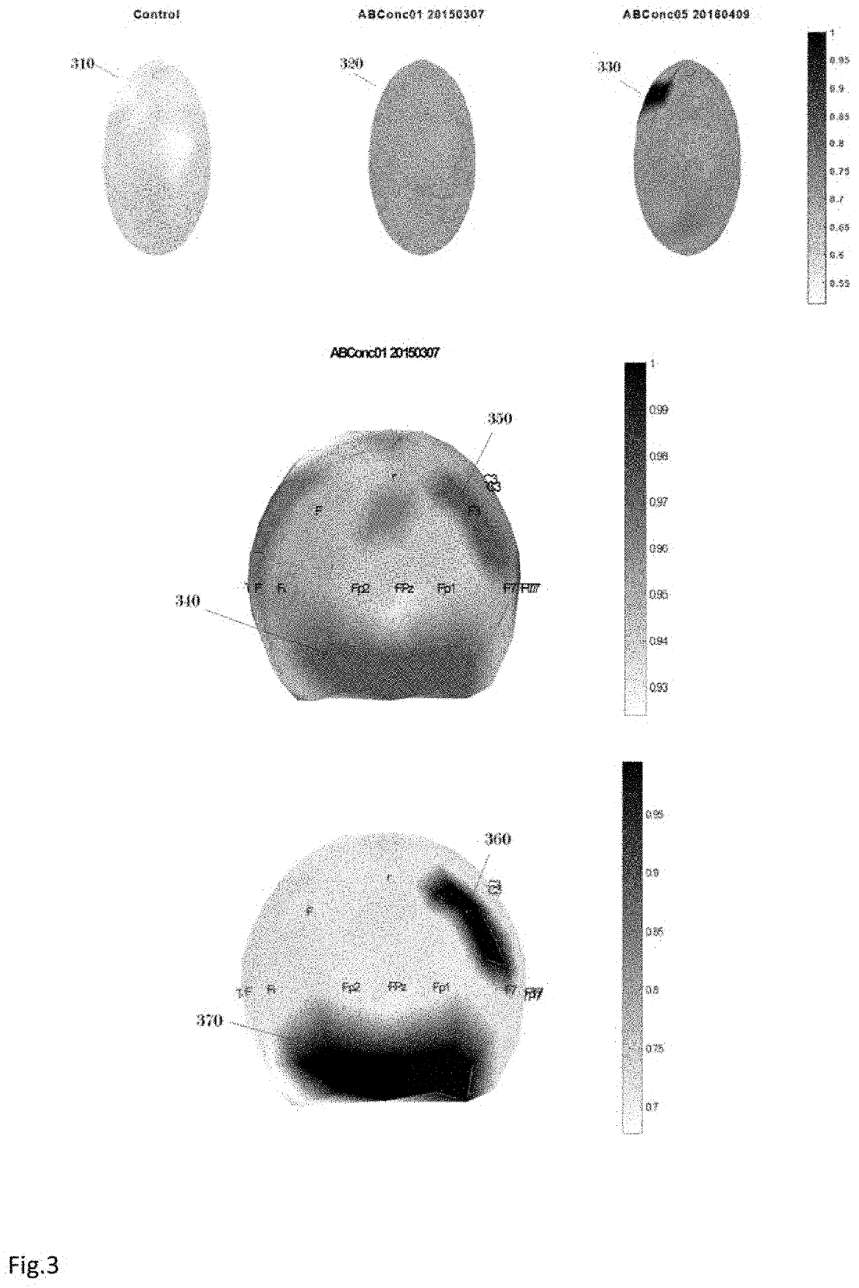 Method and system for mapping brain dysfunction for psychiatric and neurological disorders