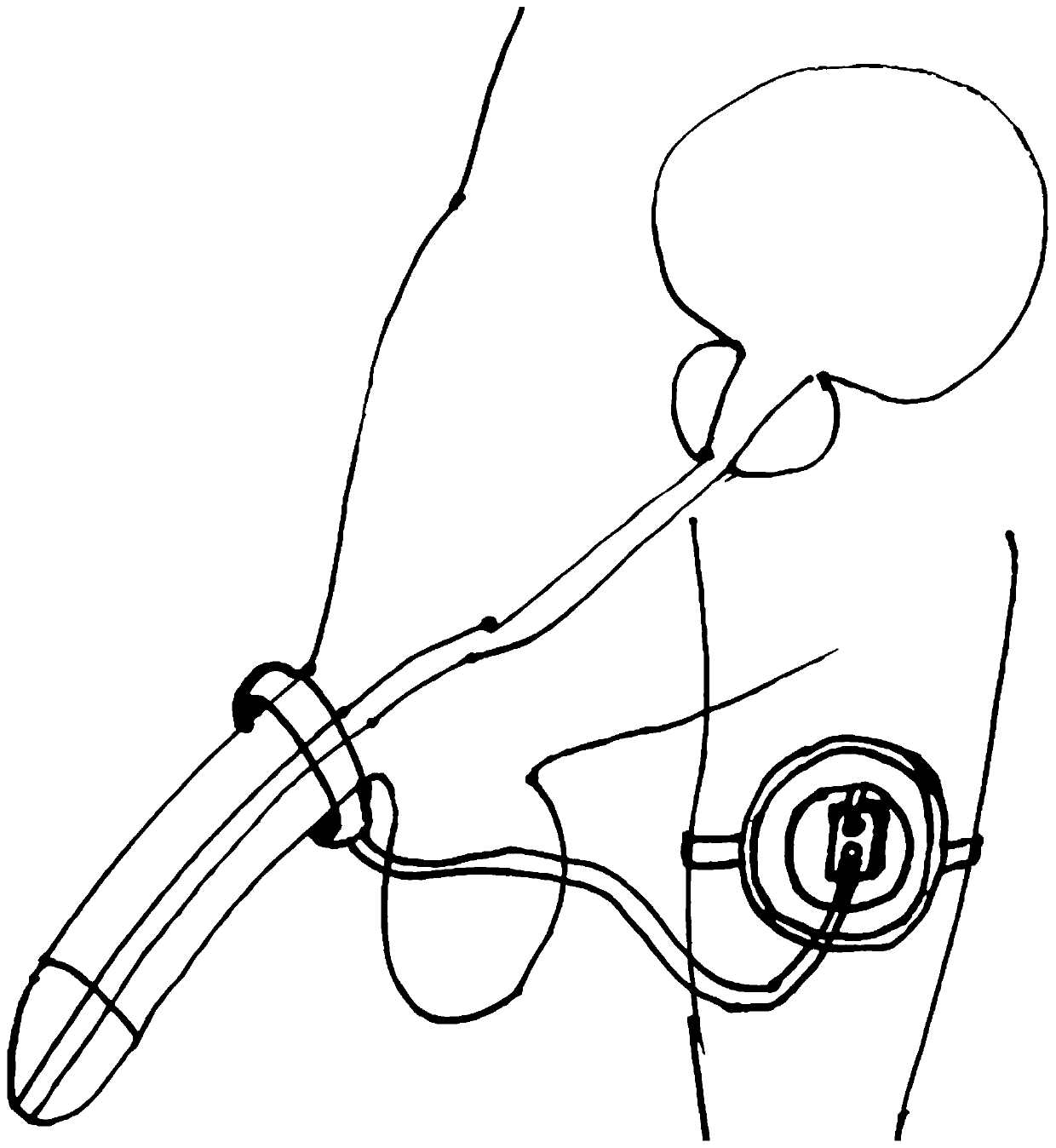 External artificial urethral sphincter device