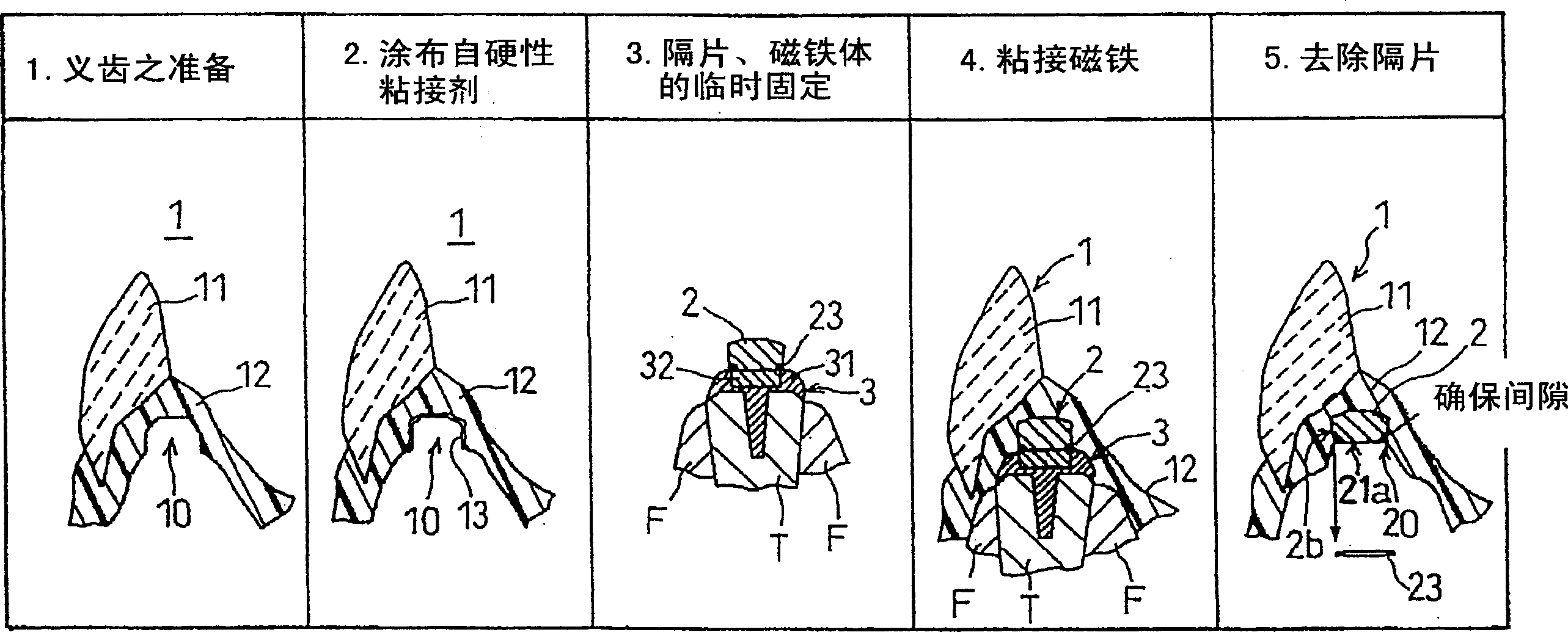 False tooth attachment and method and spacer for fixing same