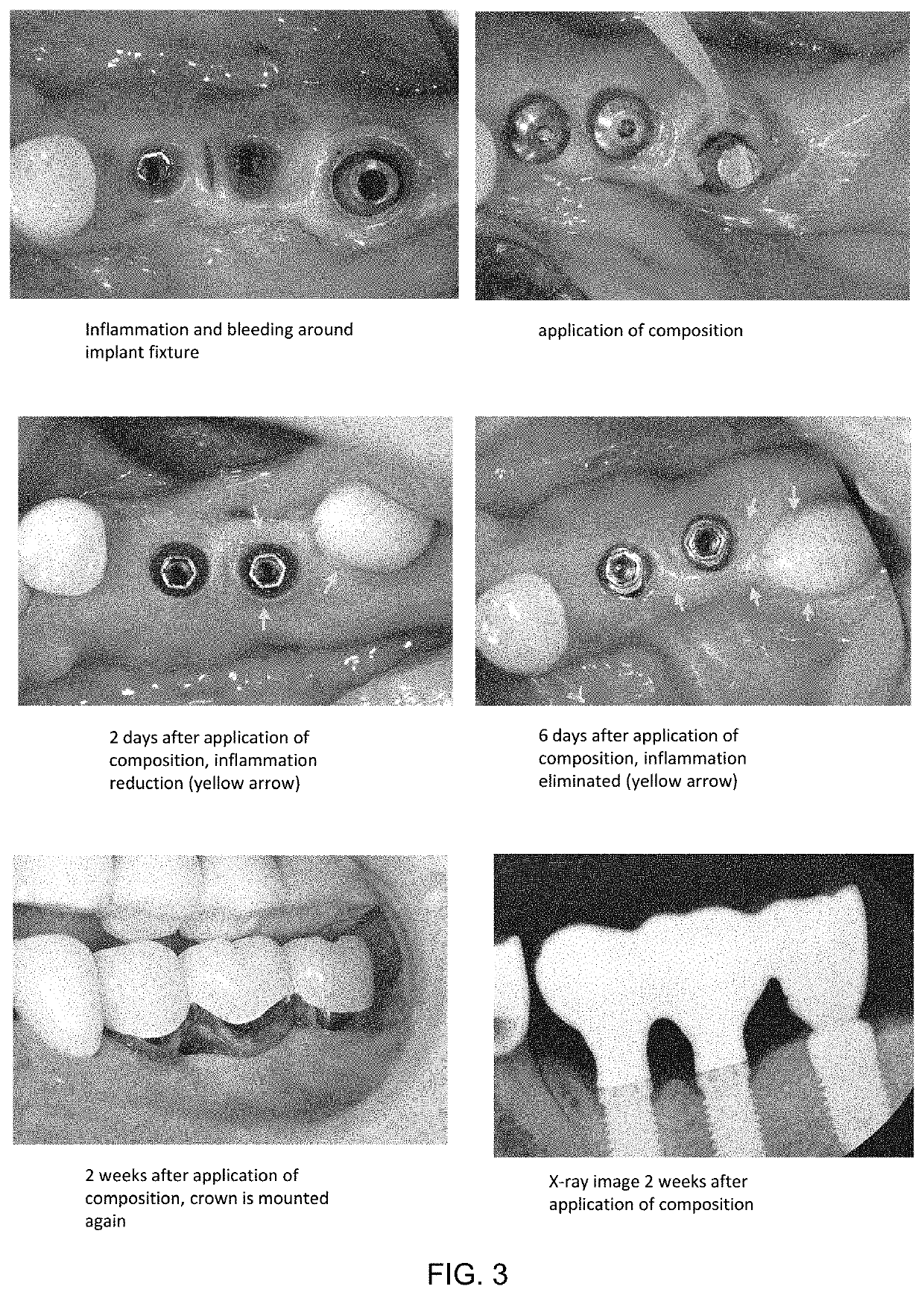 Composition for treating and preventing gingivoperiodontitis or peri-implantitis, and interdental brush coated with same