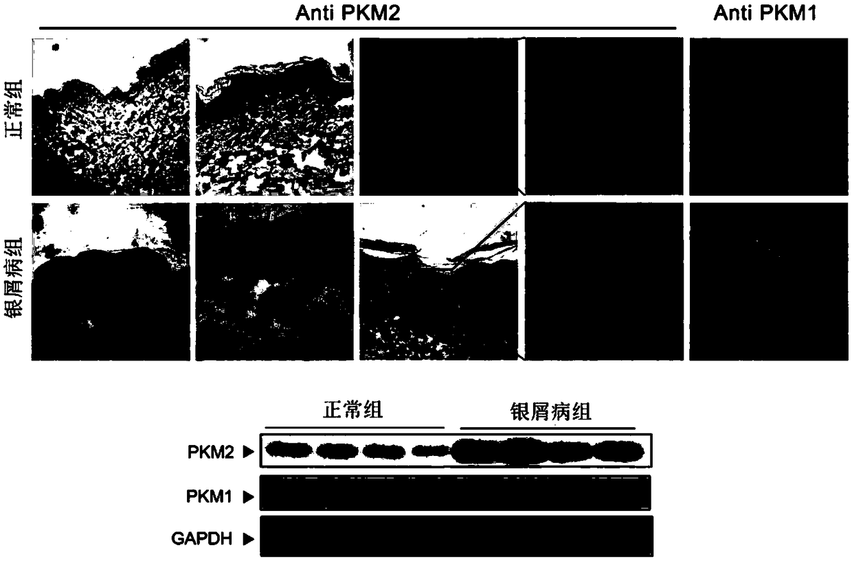 Application of M2 pyruvate kinase as drug target in preparation of drugs for prevention and treatment of psoriasis