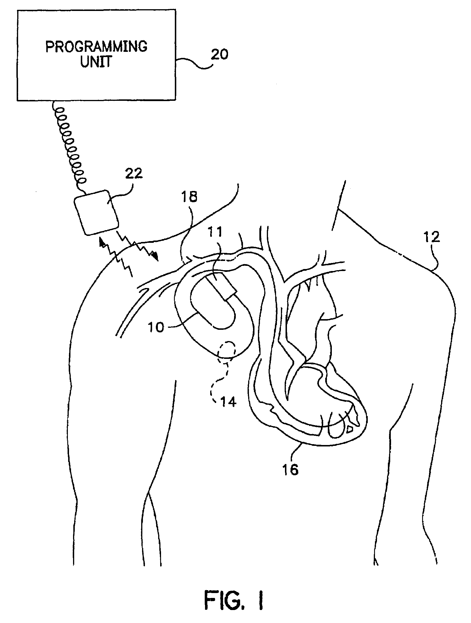 Method of optimizing mechanical heart rate during delivery of coupled or paired pacing