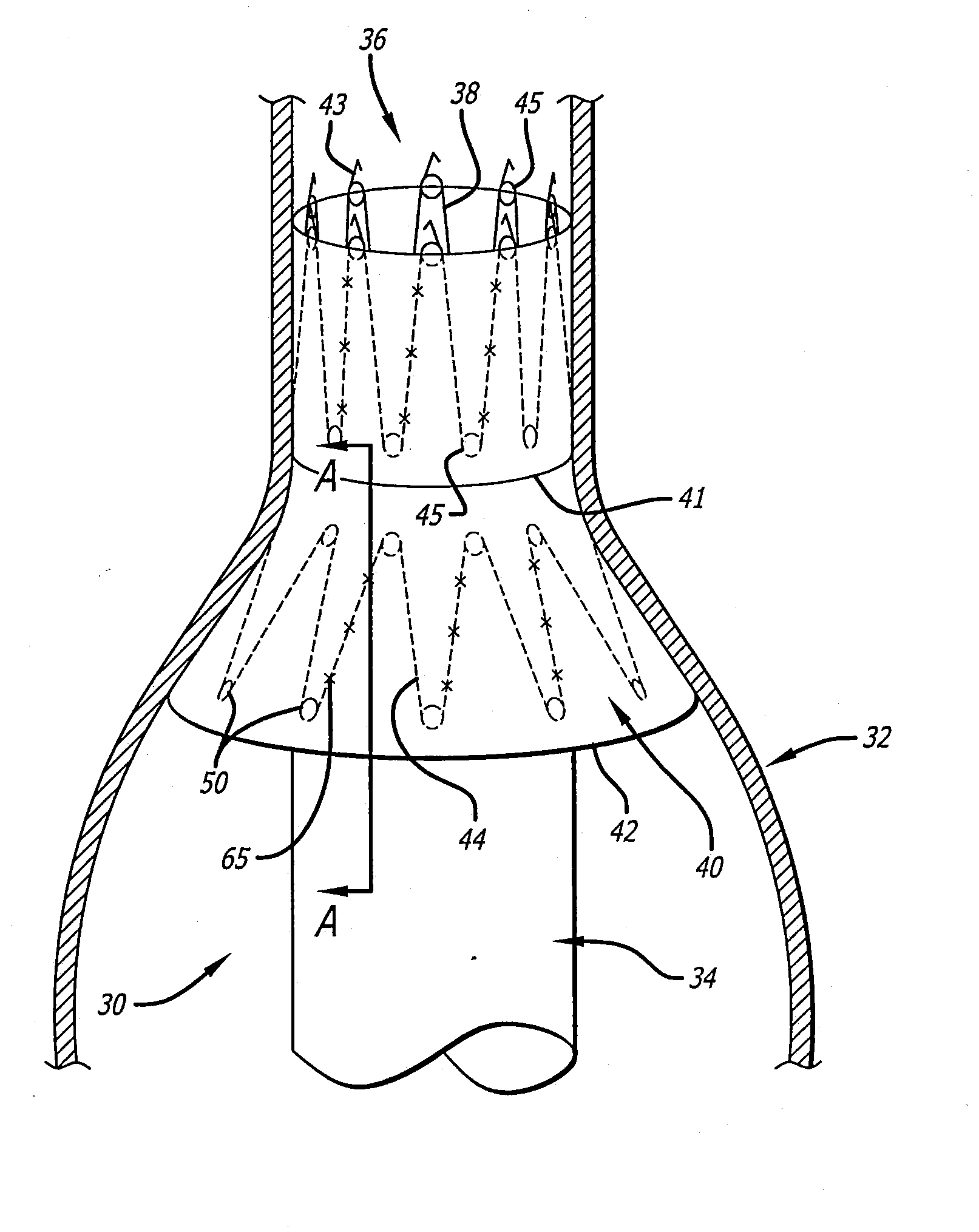 Endovascular graft for providing a seal with vasculature