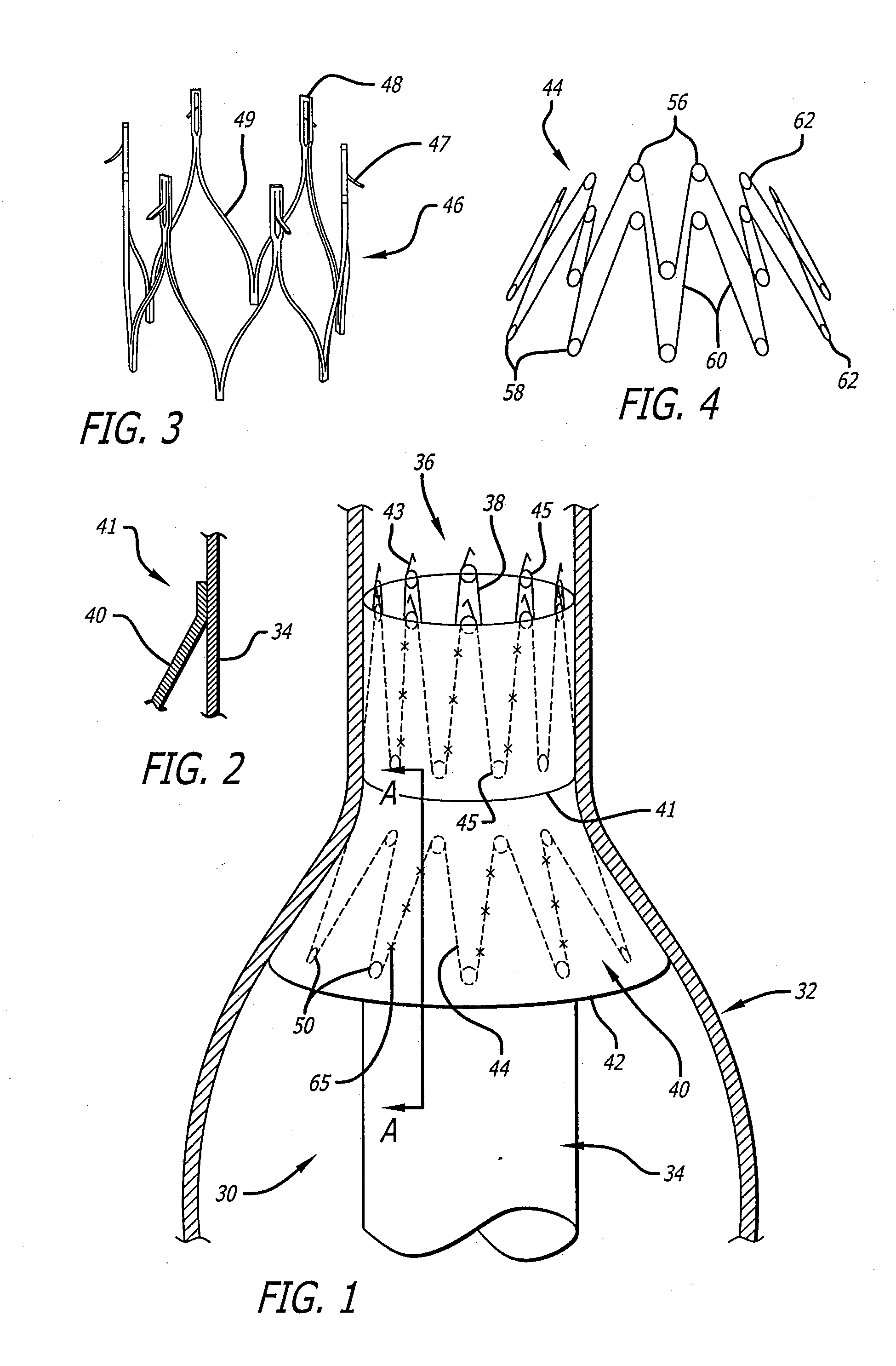 Endovascular graft for providing a seal with vasculature