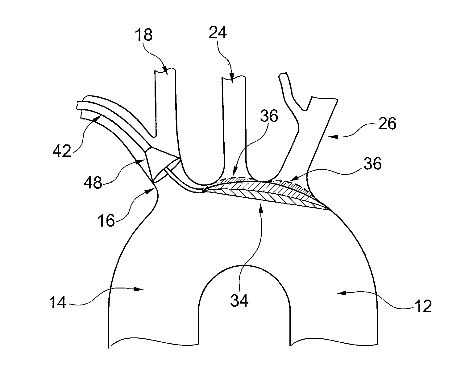 Medical device for embolic protection