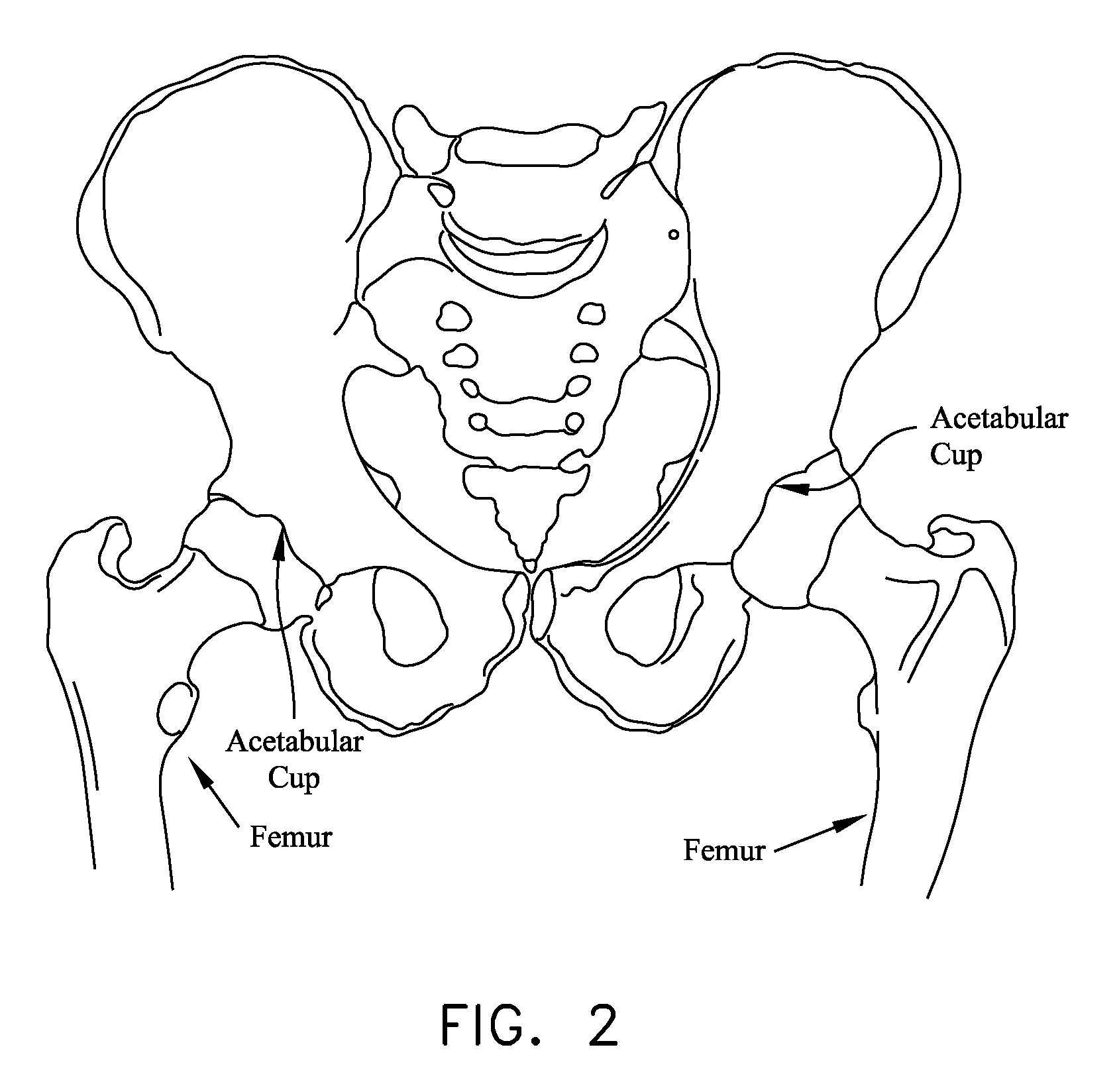 Safety needle for accessing the interior of a hip joint