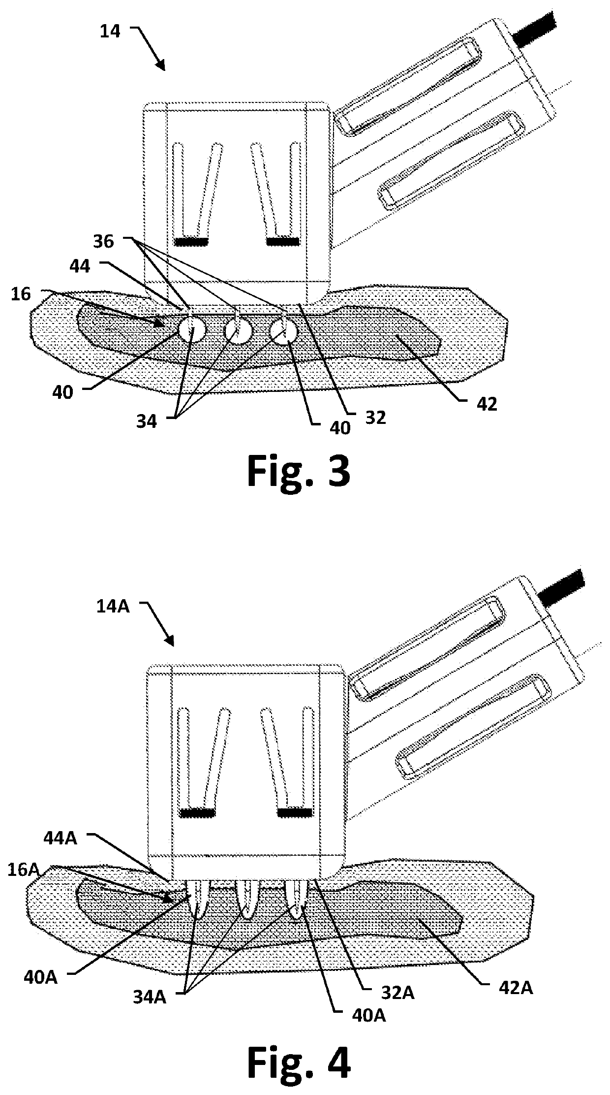 Nasal tissue treatment method and related device