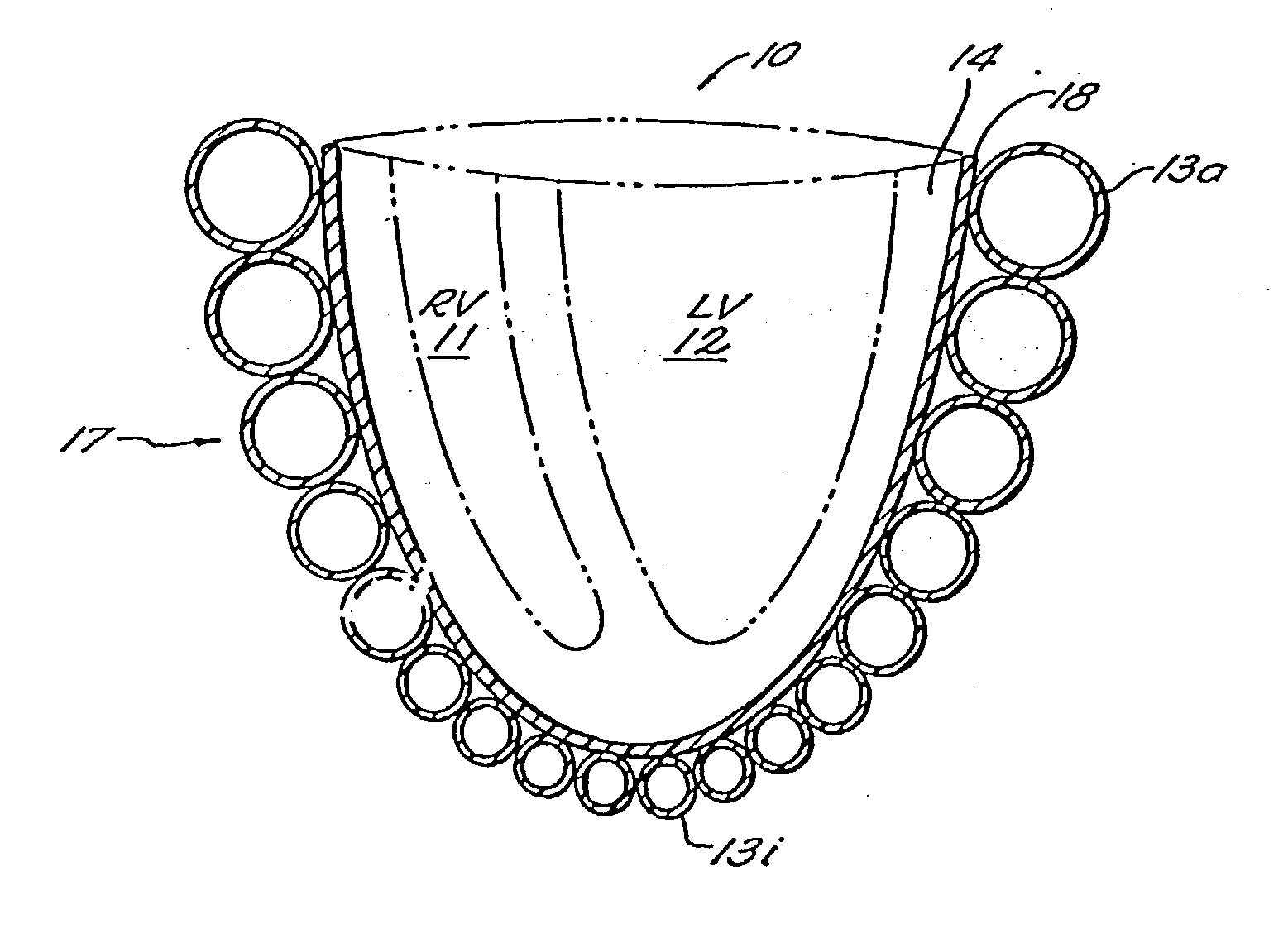 Passive cardiac assistance device