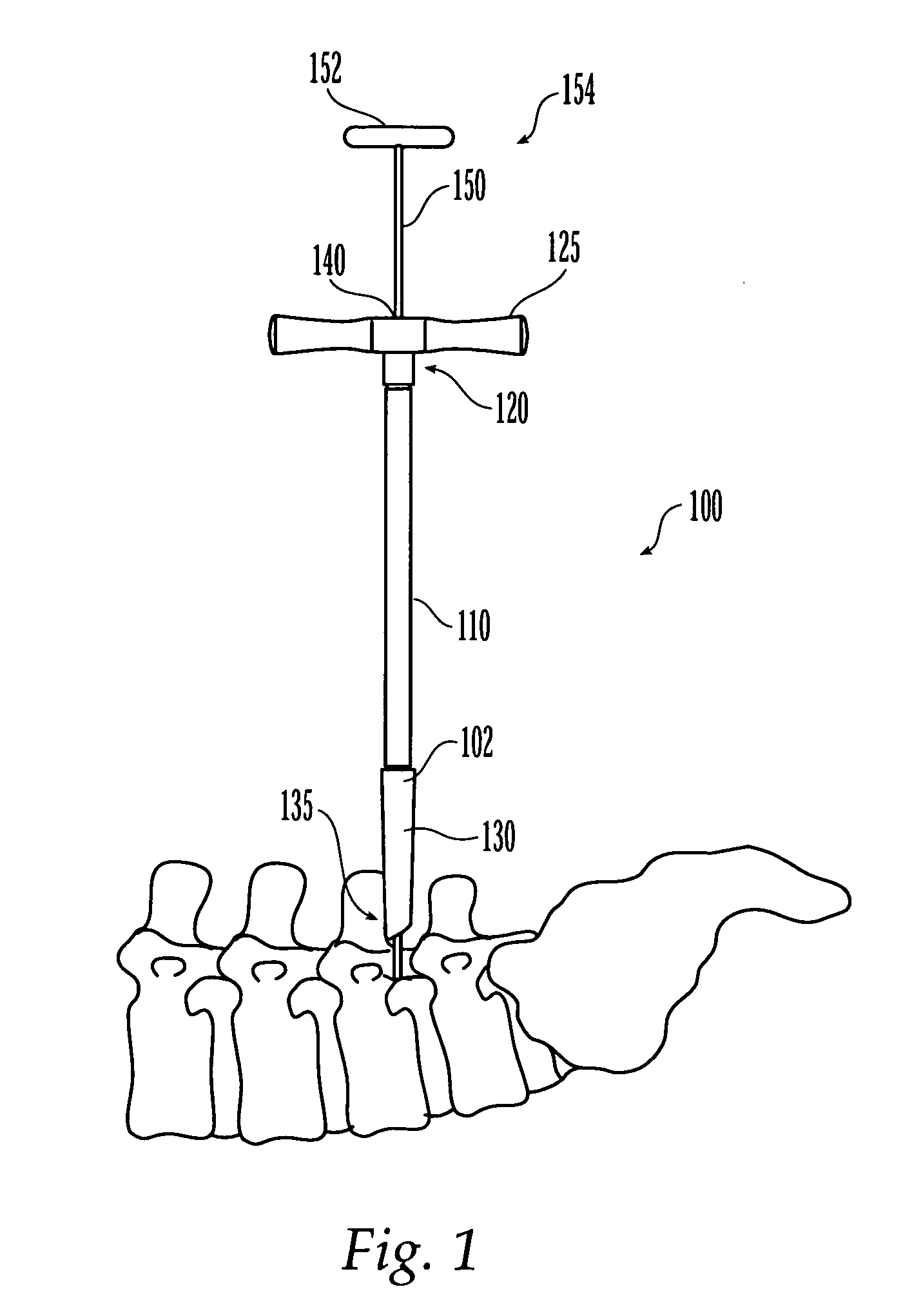 Less invasive surgical system and methods