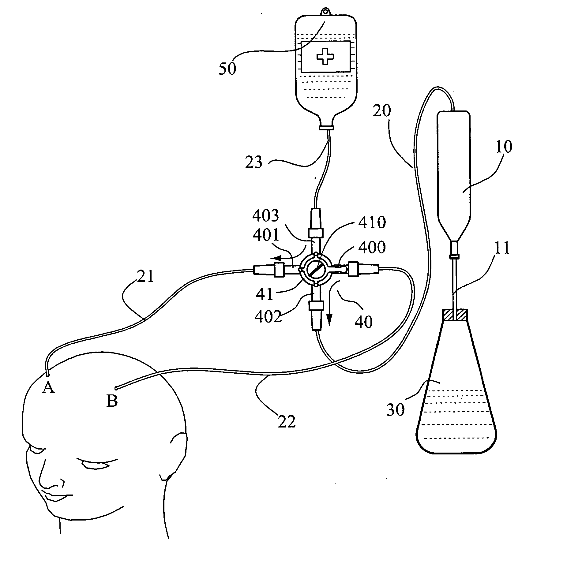Medical bi-directional in-out switchable irrigation-drainage system for intracranial surgery