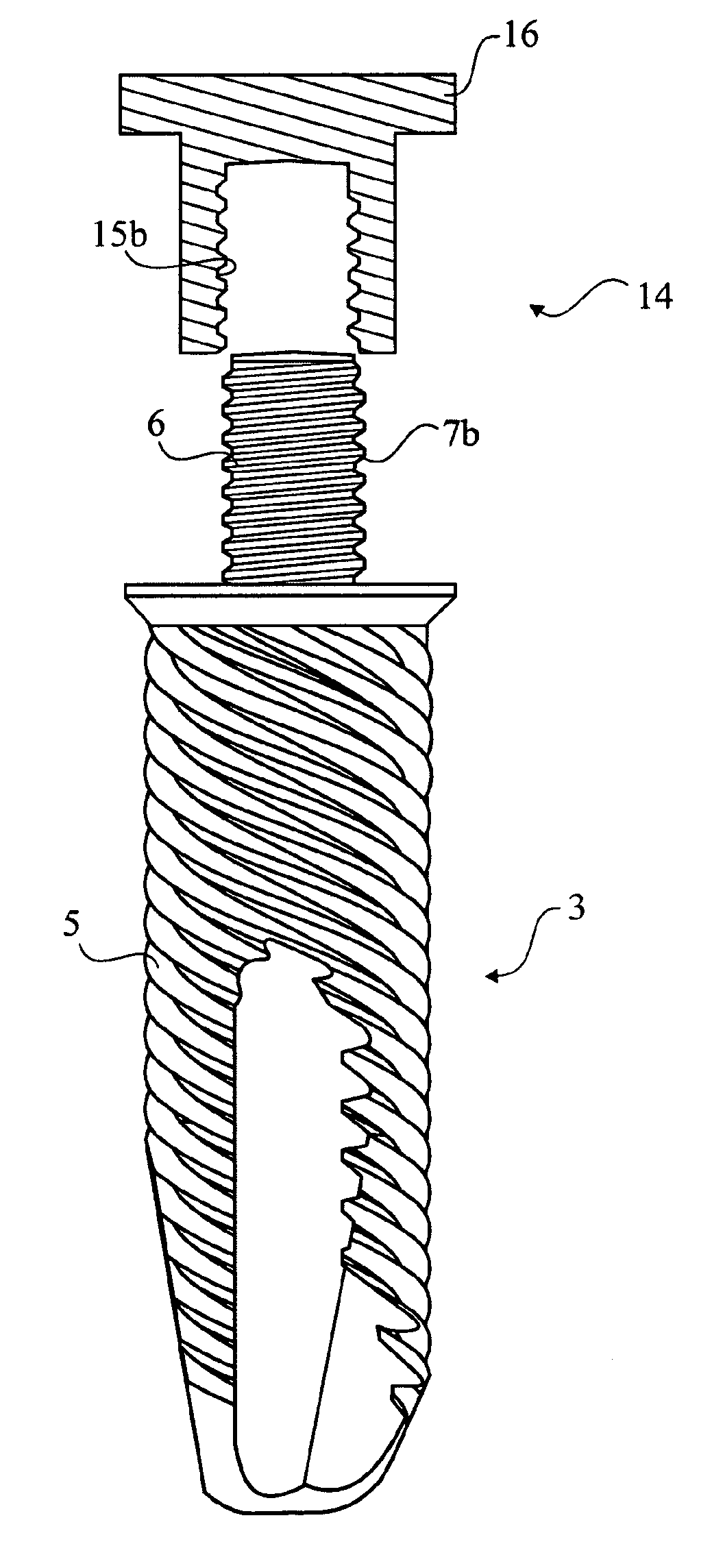 Dental implant, a dental implant kit and a method of securing a dental bridge to the jaw of the patient