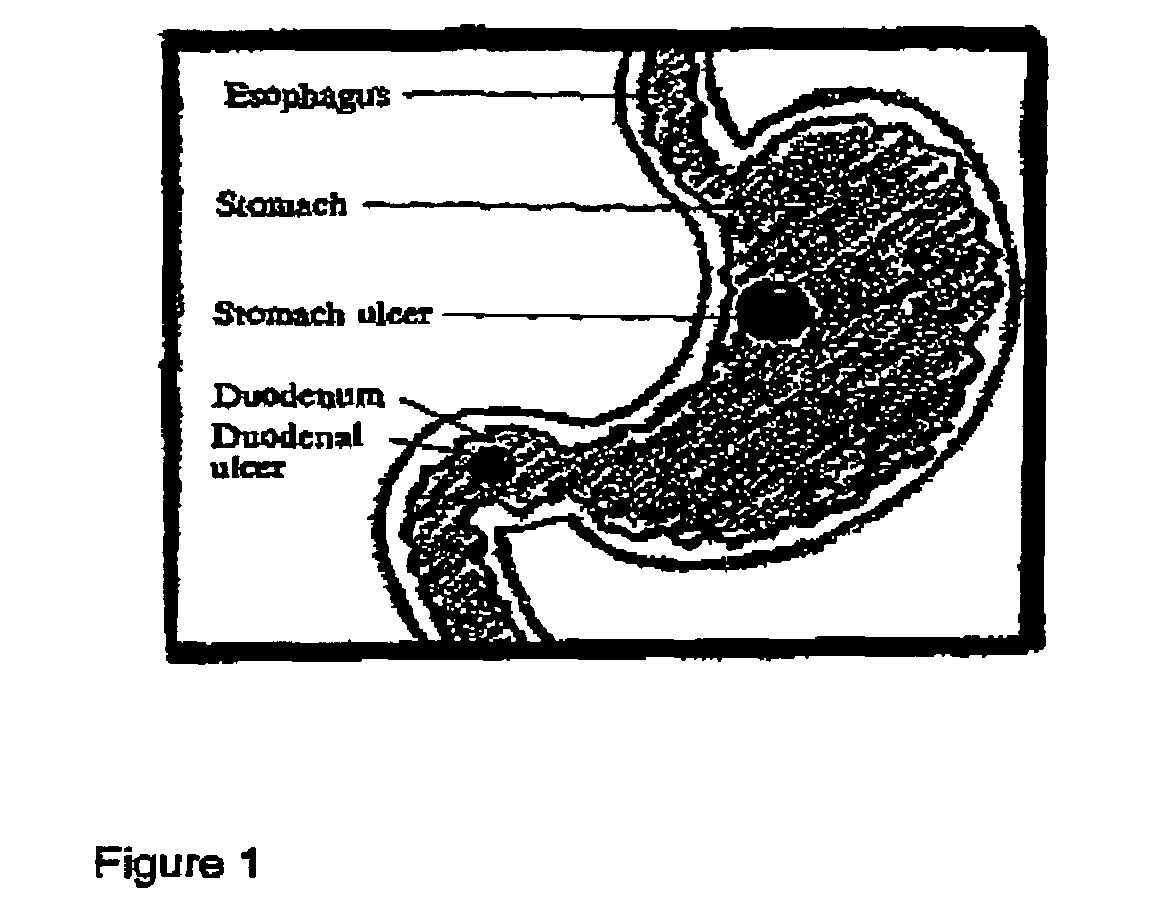 Methods for treating ulcers and gastroesophageal reflux disease