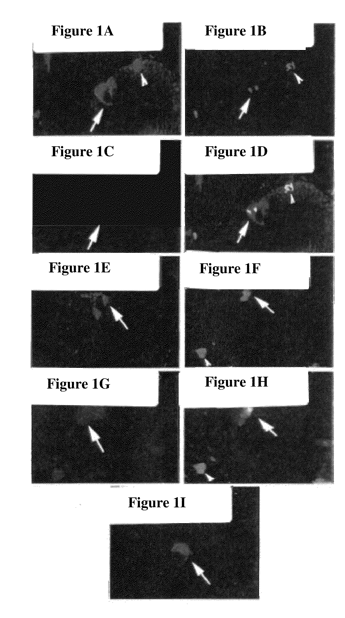 Bone augmentation utilizing muscle-derived progenitor compositions, and treatments thereof