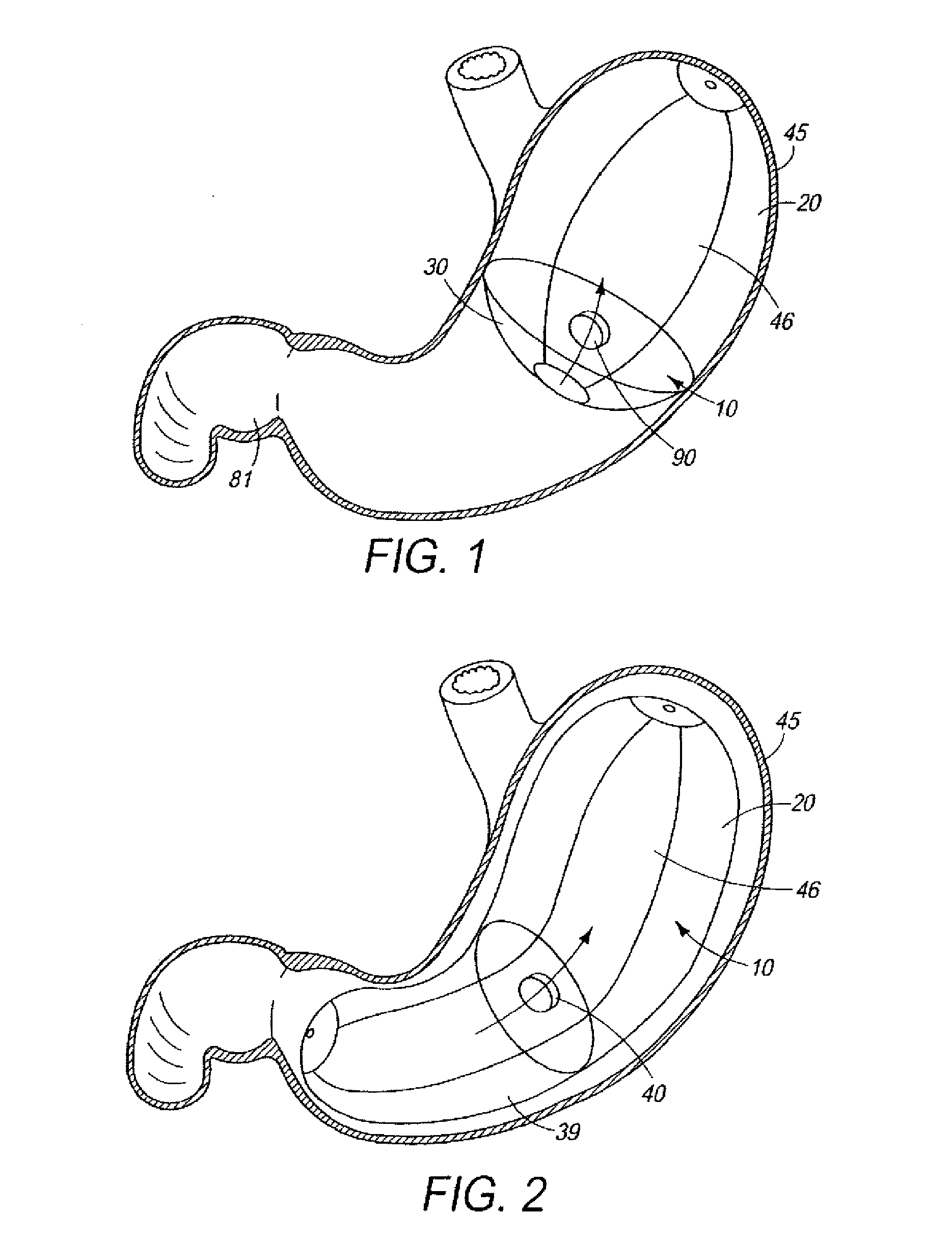 Dynamic volume displacement weight loss device