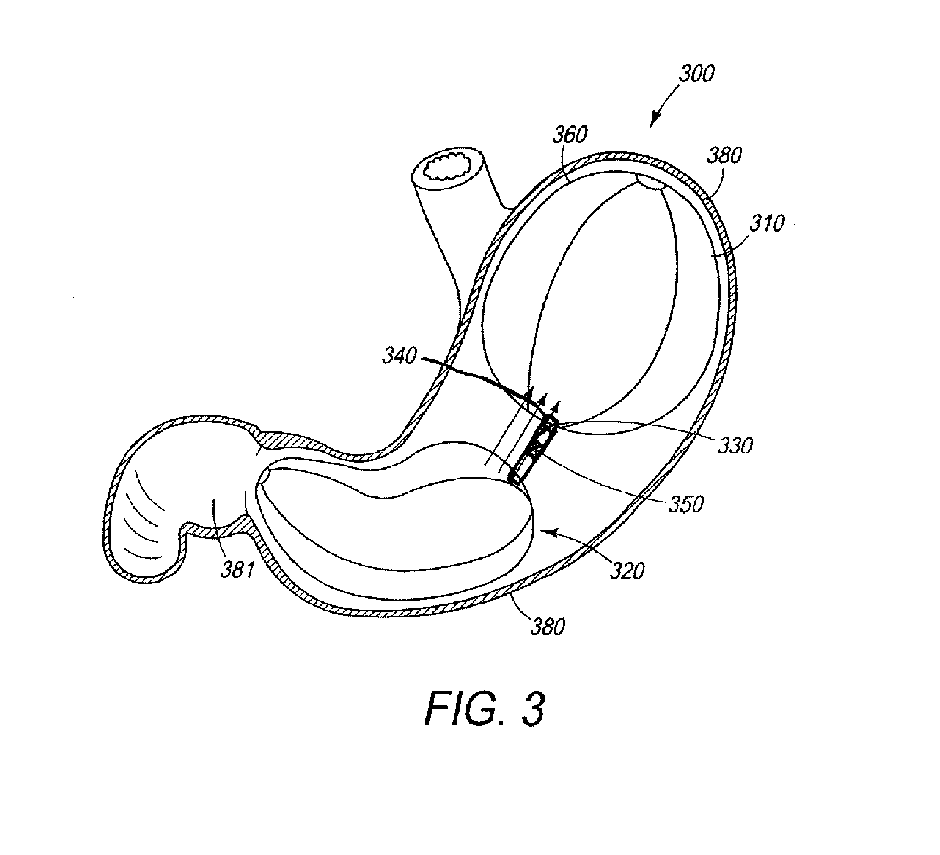 Dynamic volume displacement weight loss device
