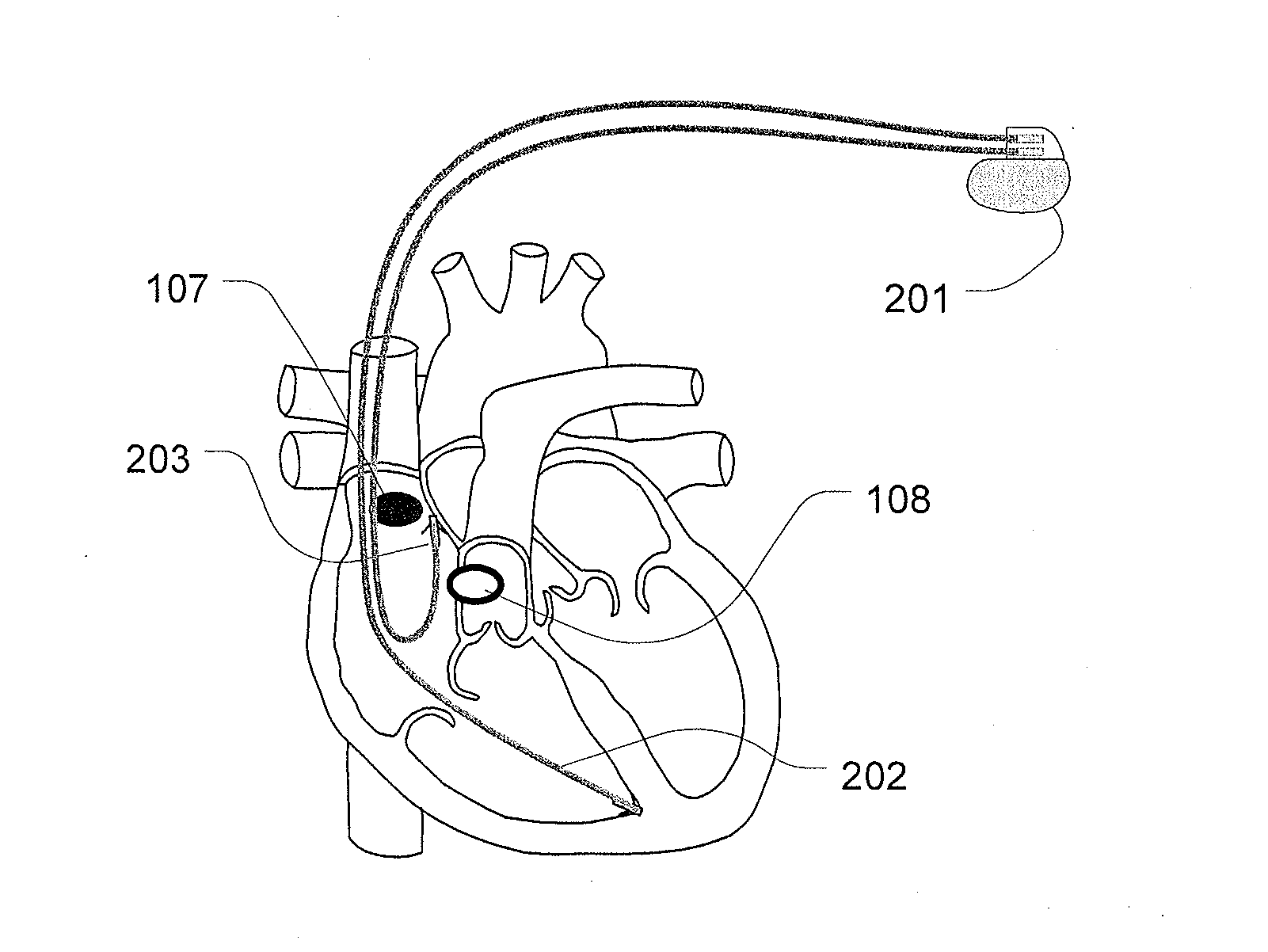 Methods and Apparatus to Stimulate the Heart