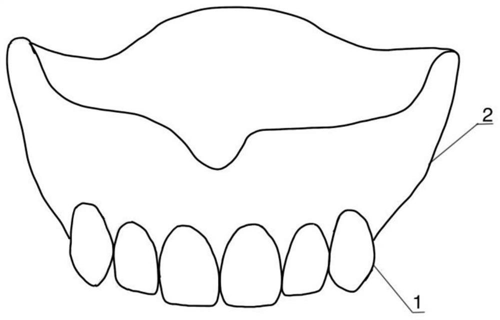 Maxillary edentulous jaw tray with aesthetic forecasting function