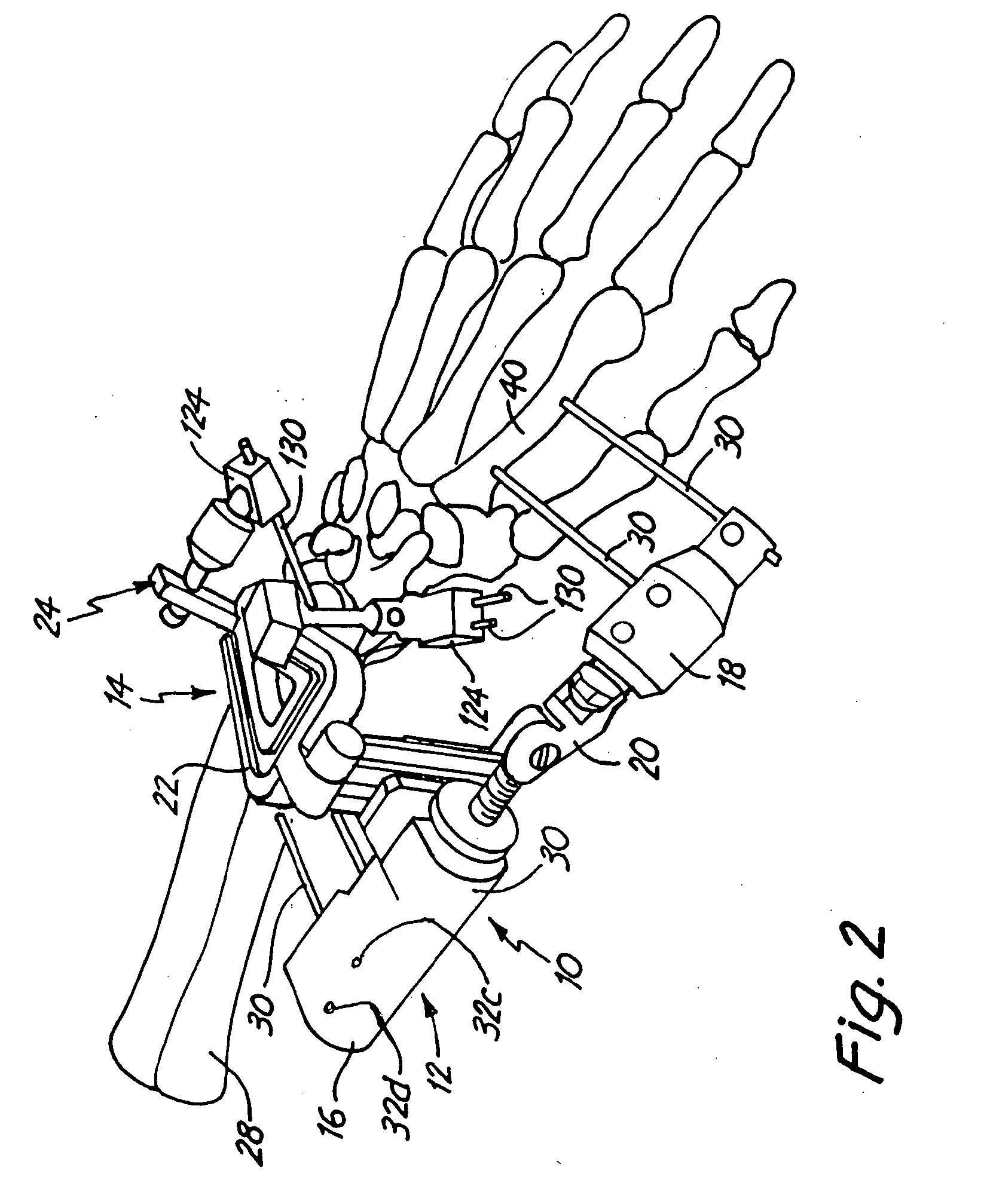 Method Of Fracture Fixation