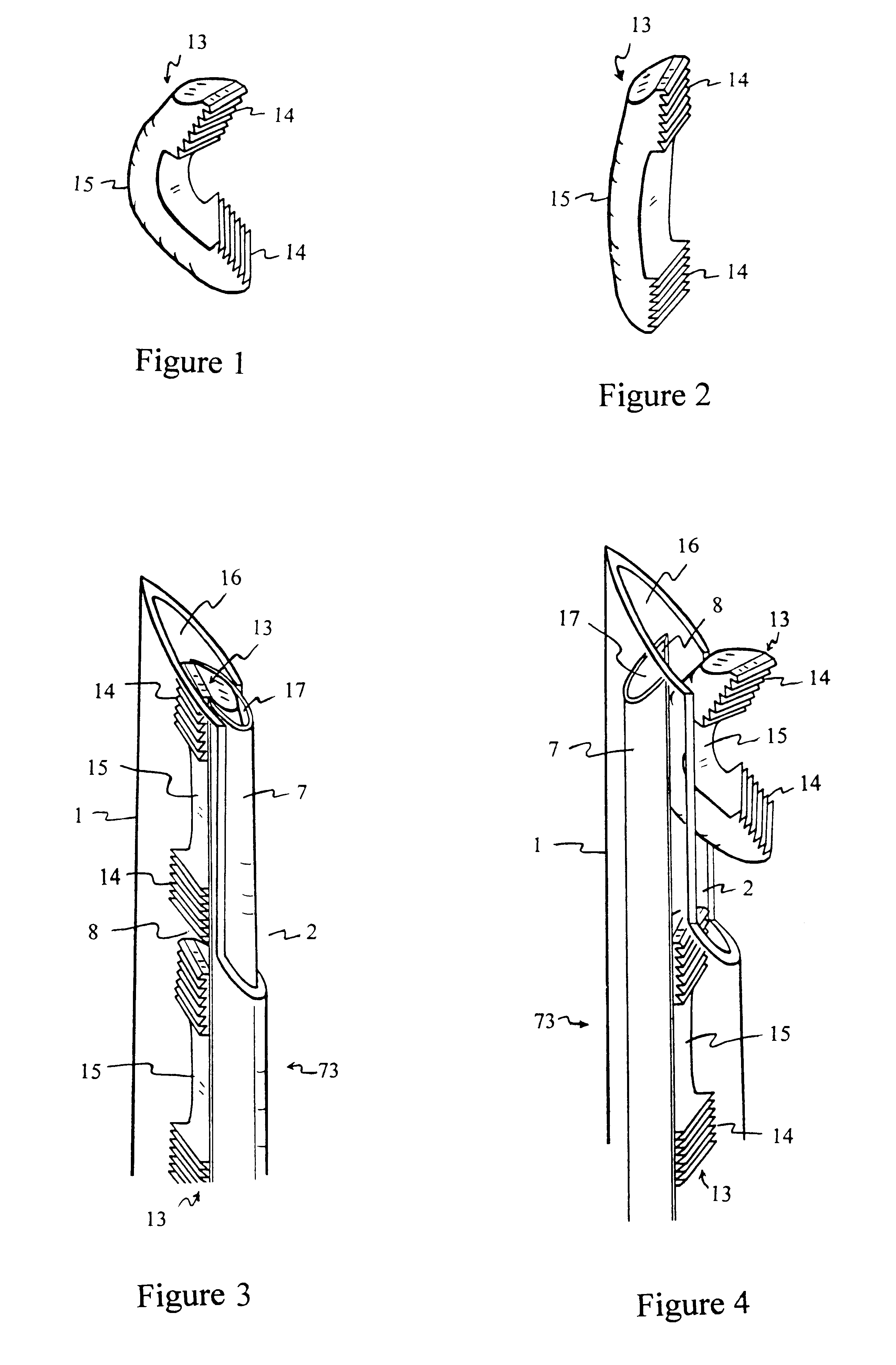 Methods and devices for fastening bulging or herniated intervertebral discs