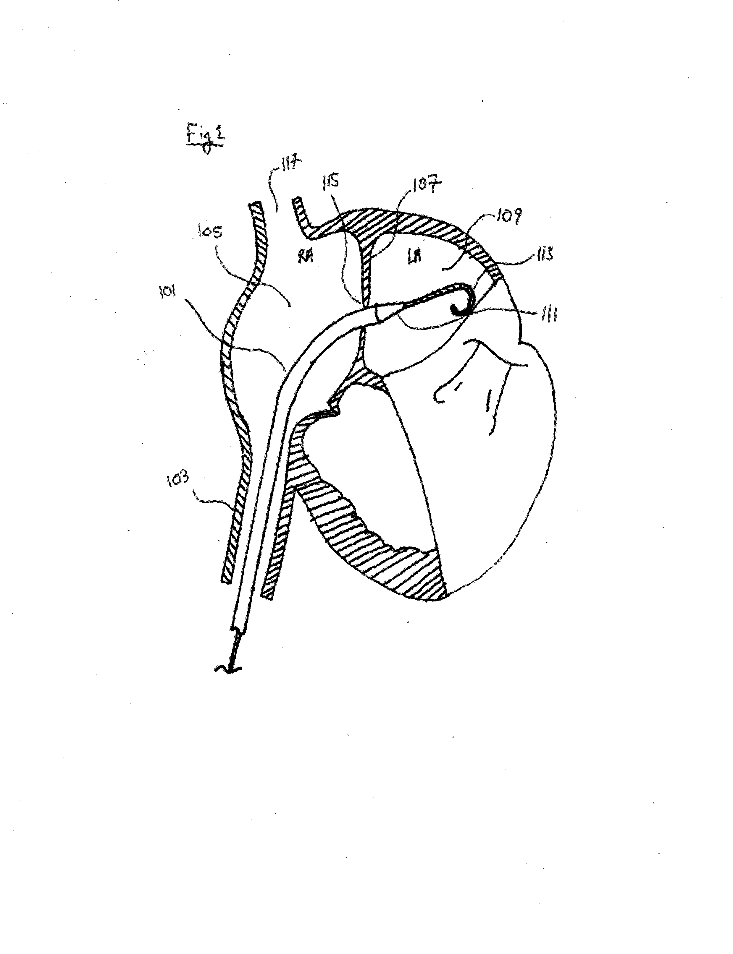 Methods and devices for intra-atrial shunts having selectable flow rates