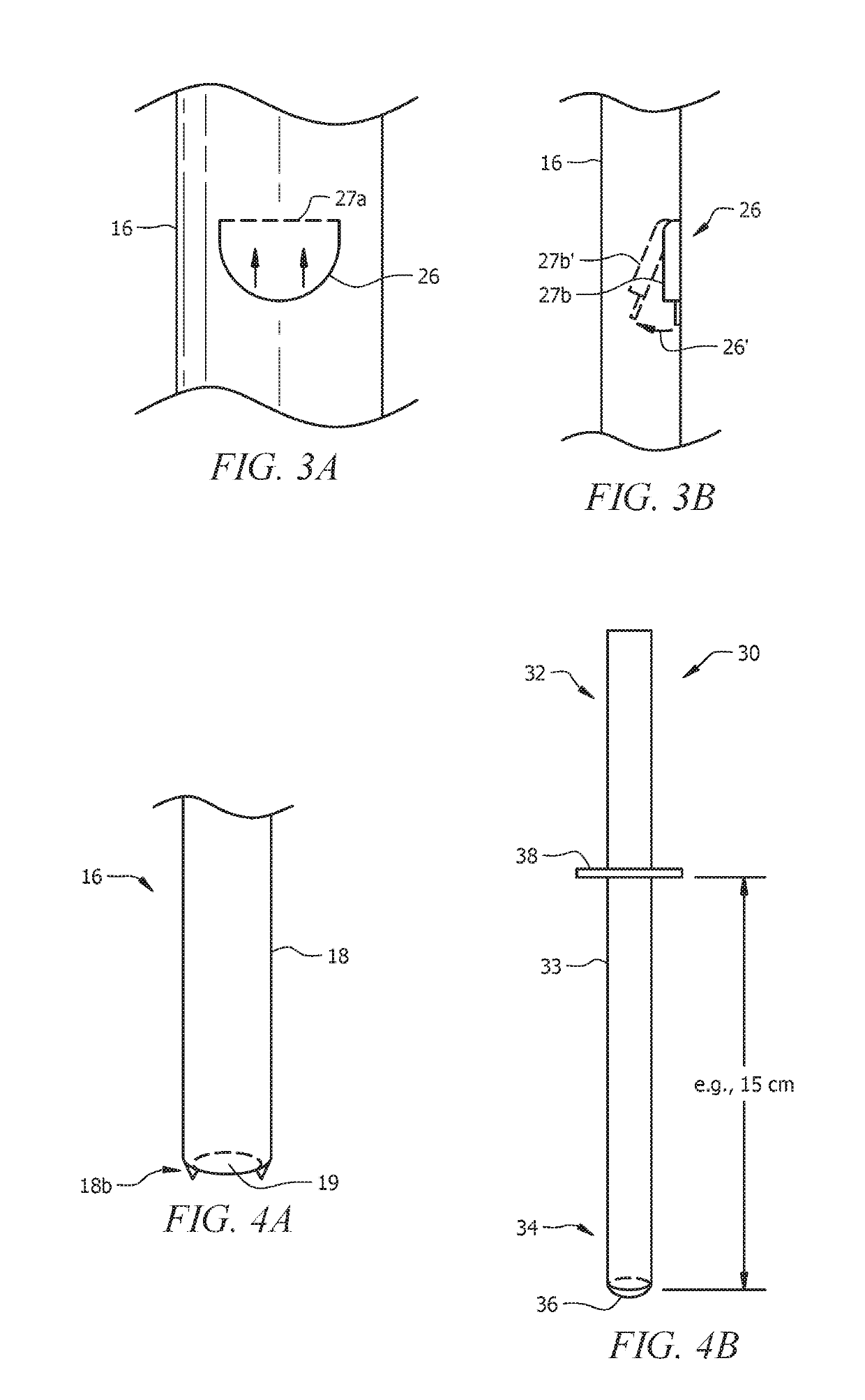 Shunt catheter system