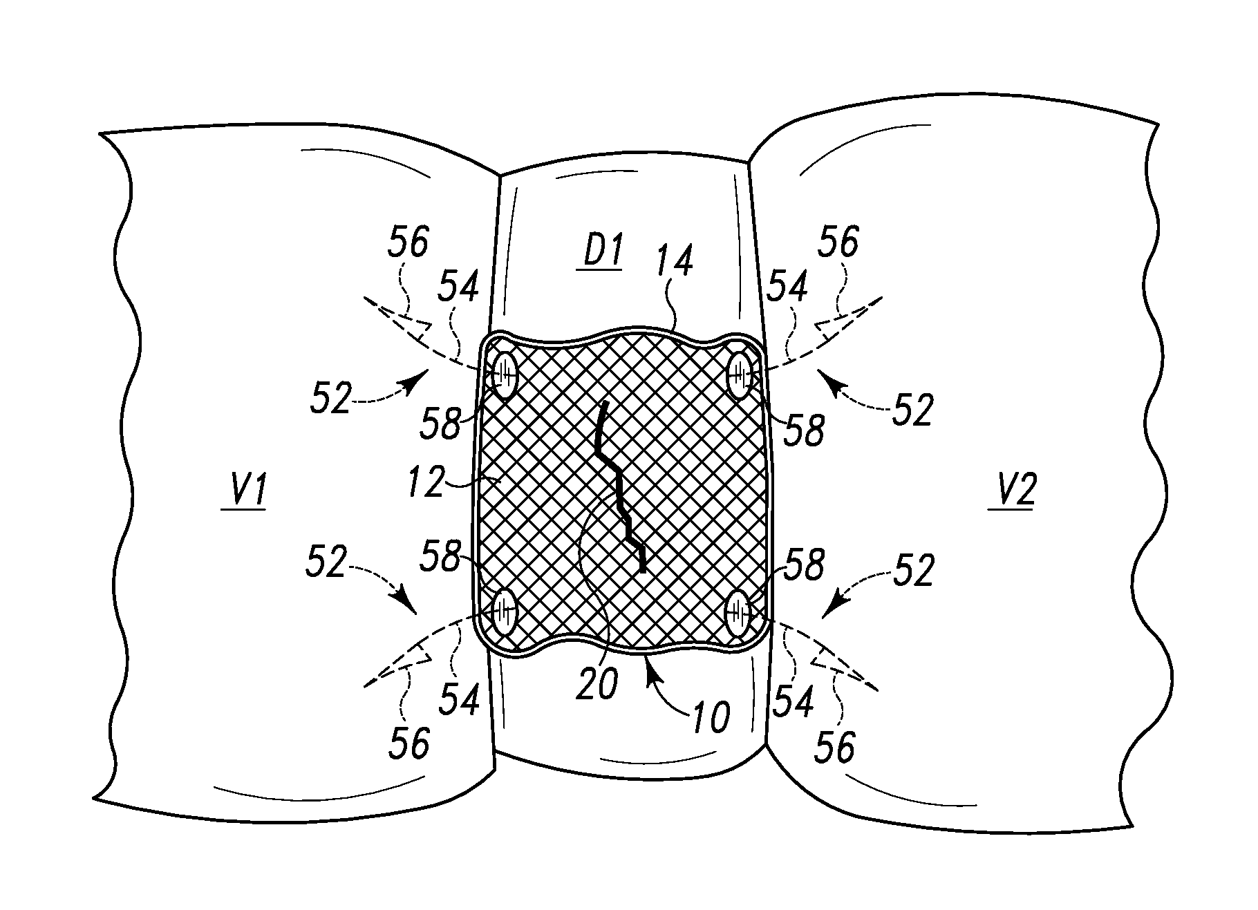 Repair System for Spinal Disc Herniation