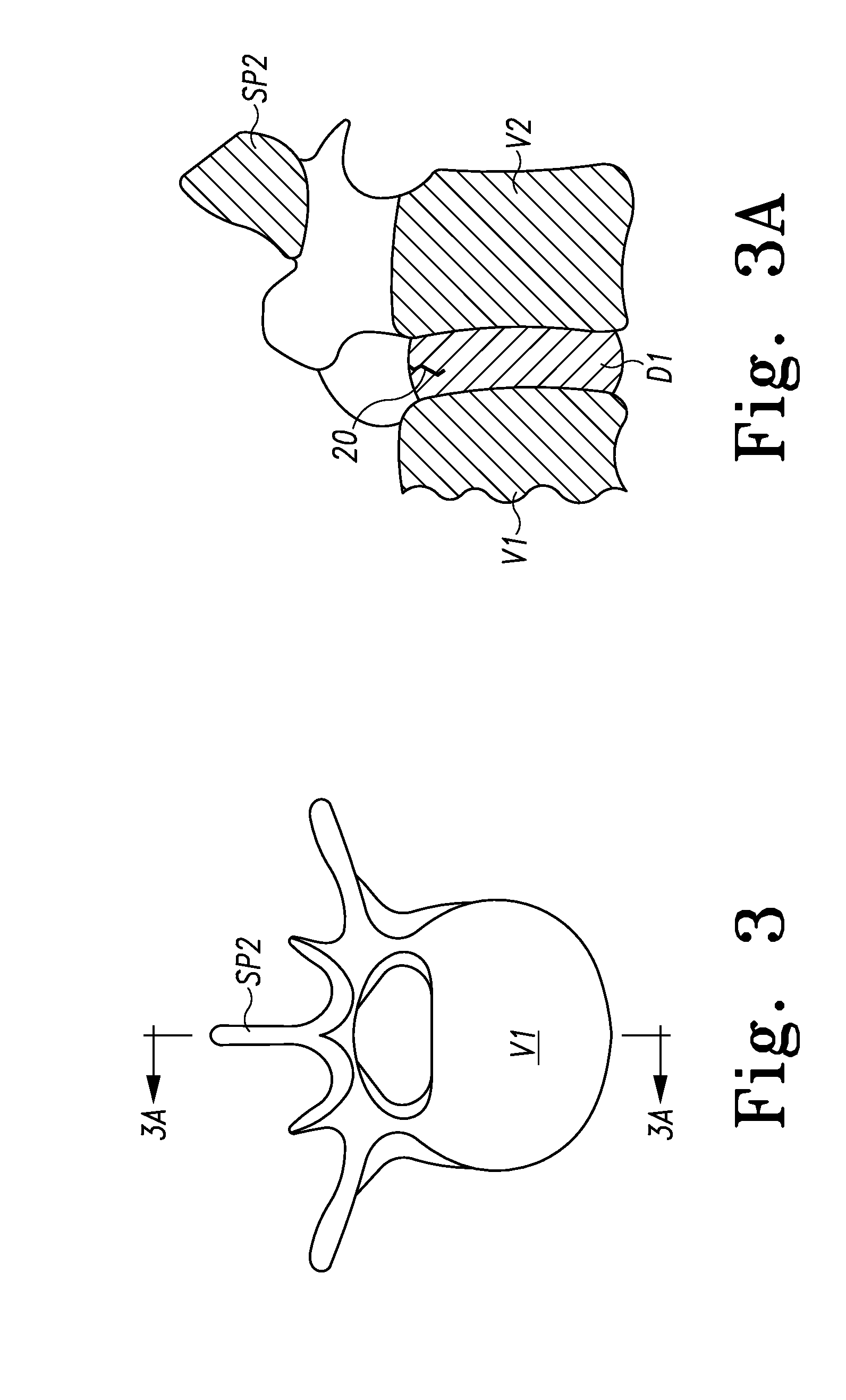 Repair System for Spinal Disc Herniation