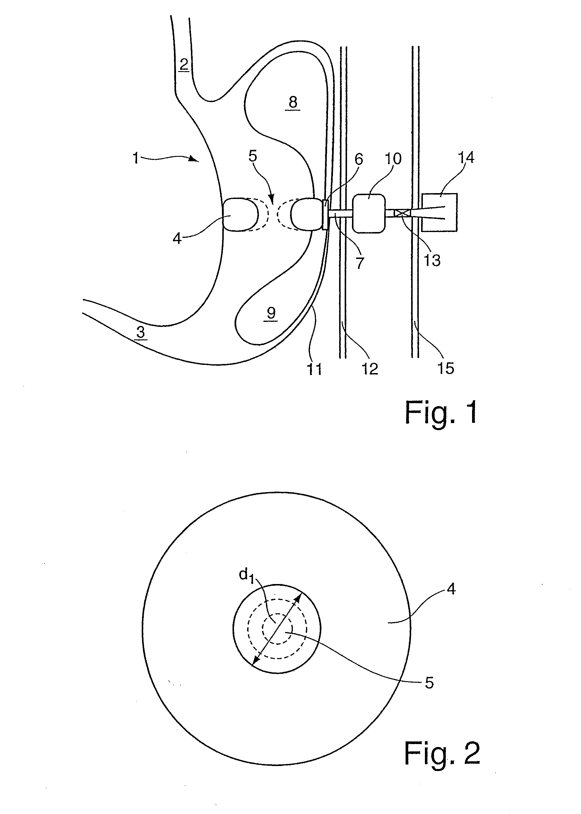 Device for treating obesity