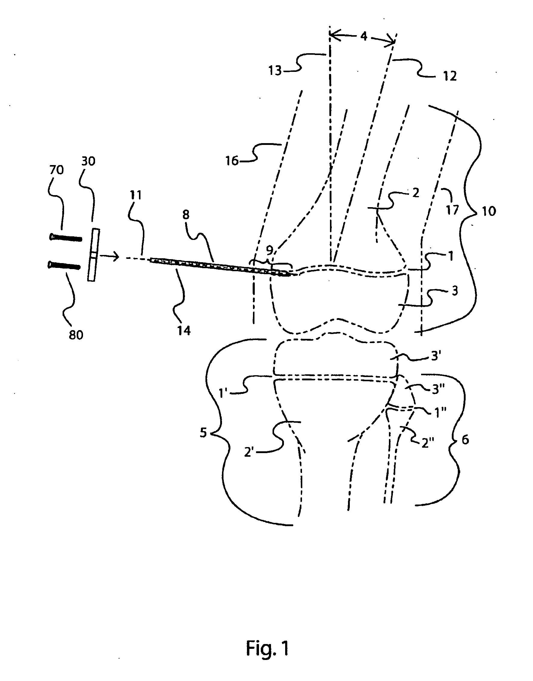 Bone alignment implant and method of use
