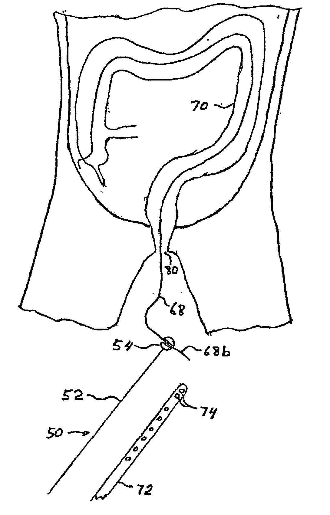 Tubular apparatus for drainage of the colon and method and guidewire for colonic intubation