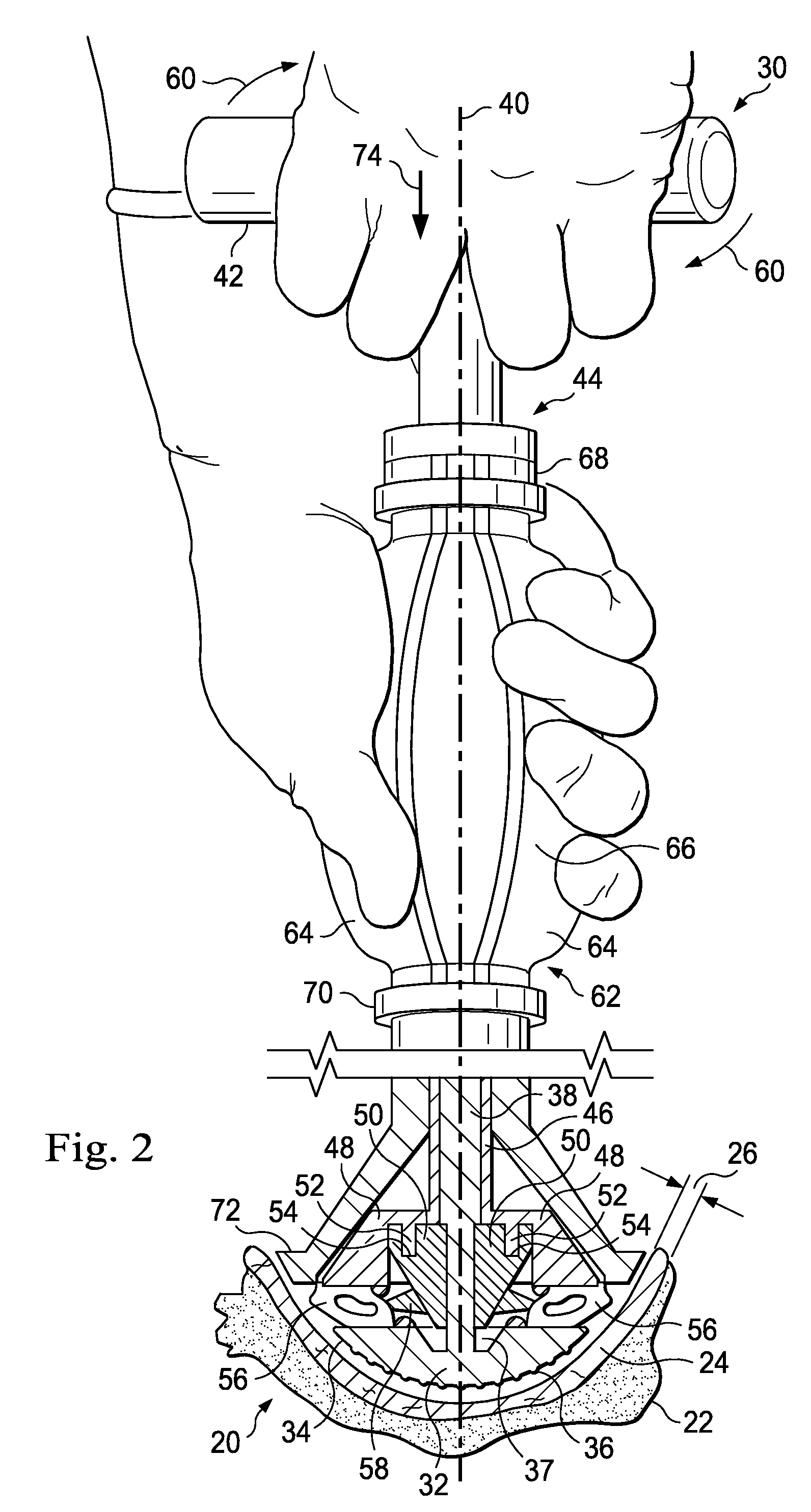 Methods, Systems, and Apparatus for Implanting Prosthetic Devices Into Cartilage