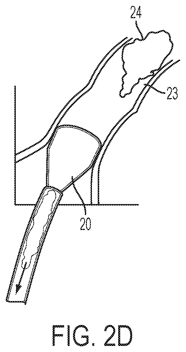 Systems and Methods for Removing Undesirable Material Within a Circulatory System