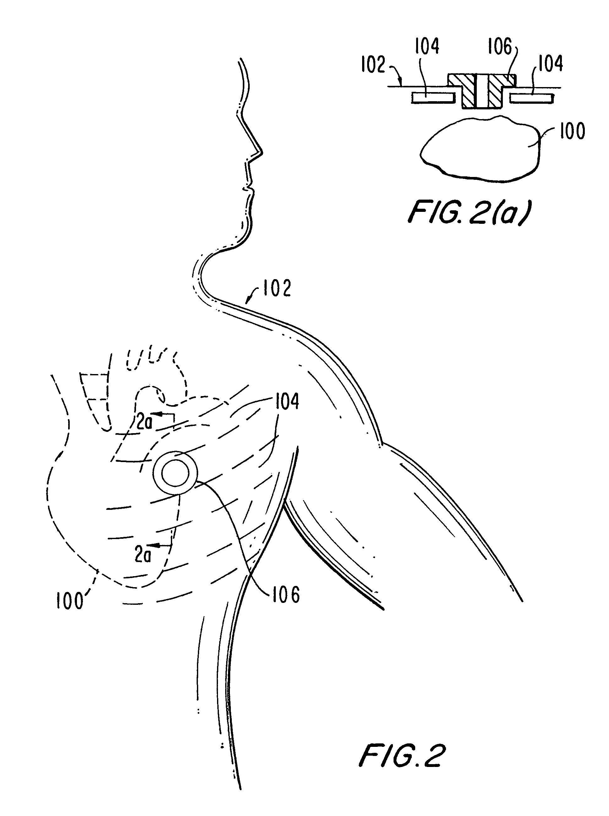 Medical grafting methods and apparatus