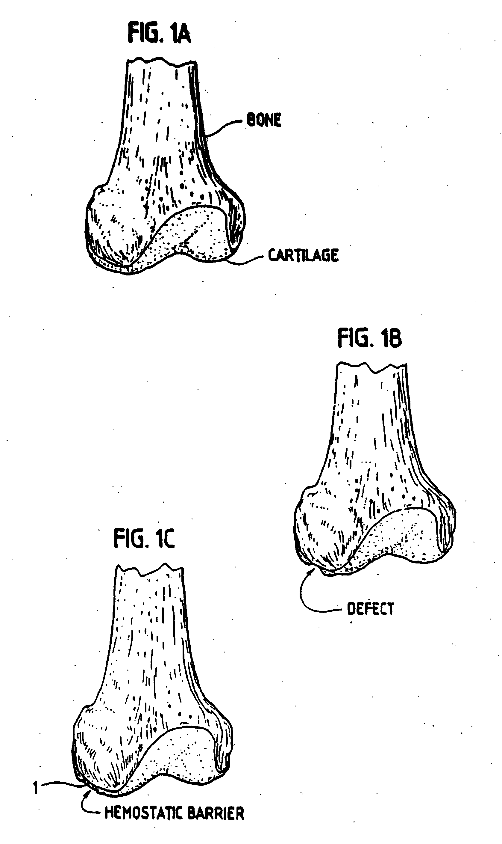 Method, instruments, and kit for autologous transplantation