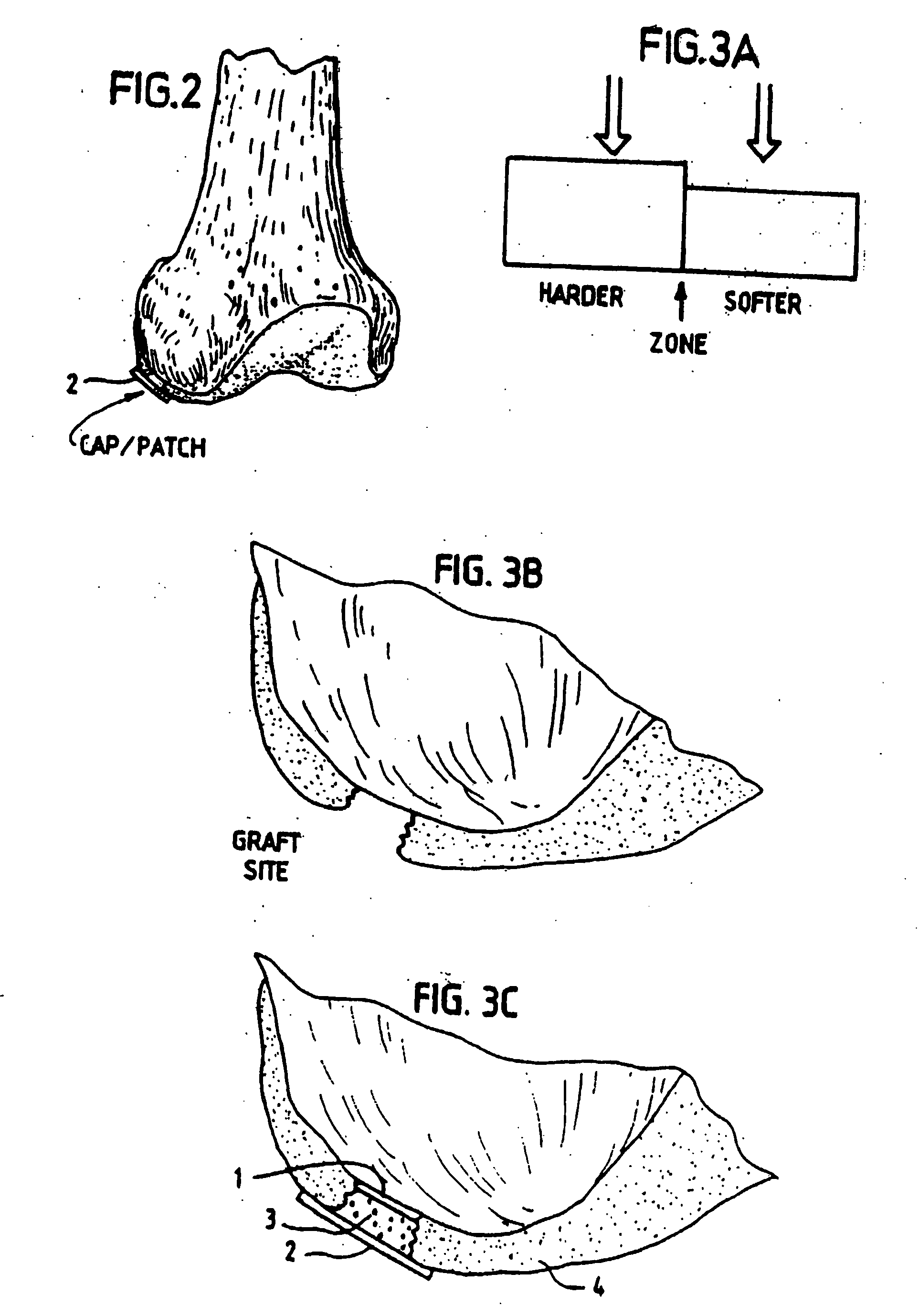 Method, instruments, and kit for autologous transplantation