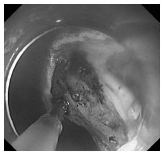 Instrument detection system and method applied to digestive endoscopic surgery video analysis