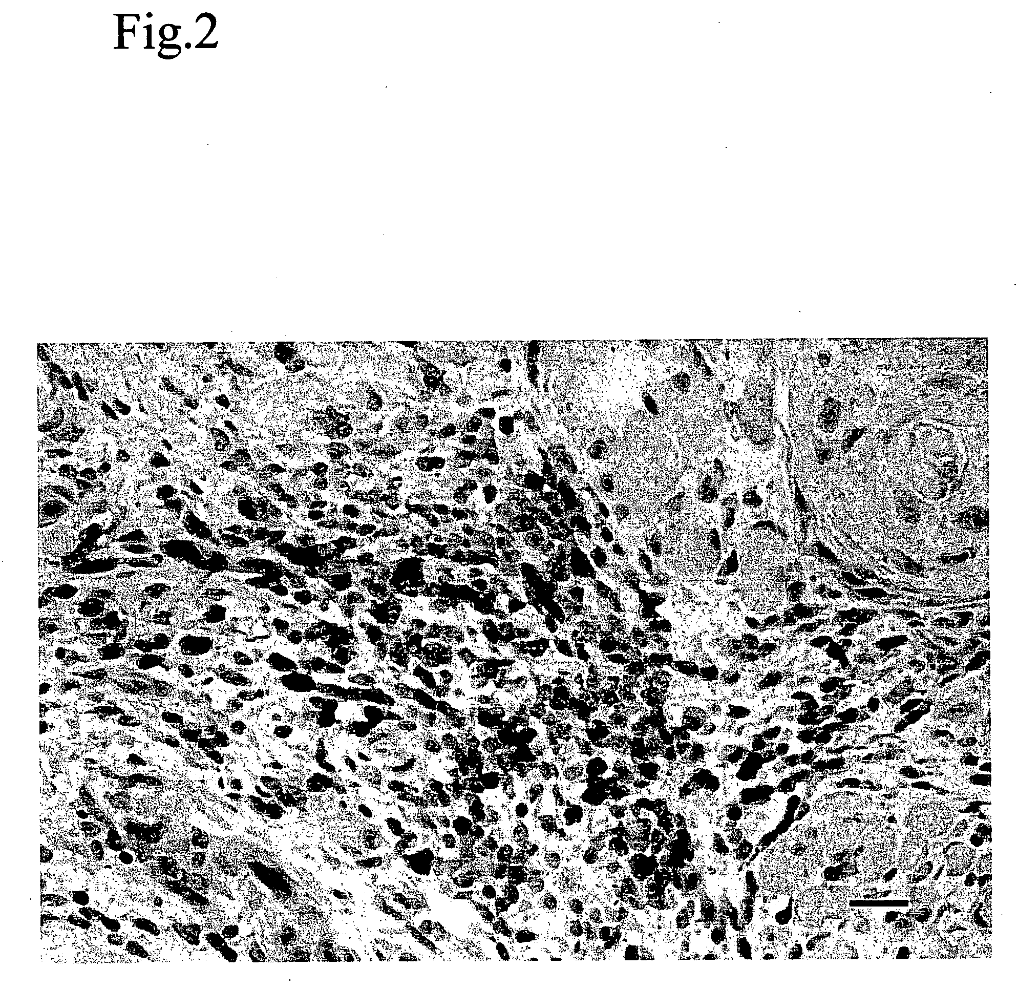 Method for modulating HLA class II tumor cell surface expression with a cytokine mixture