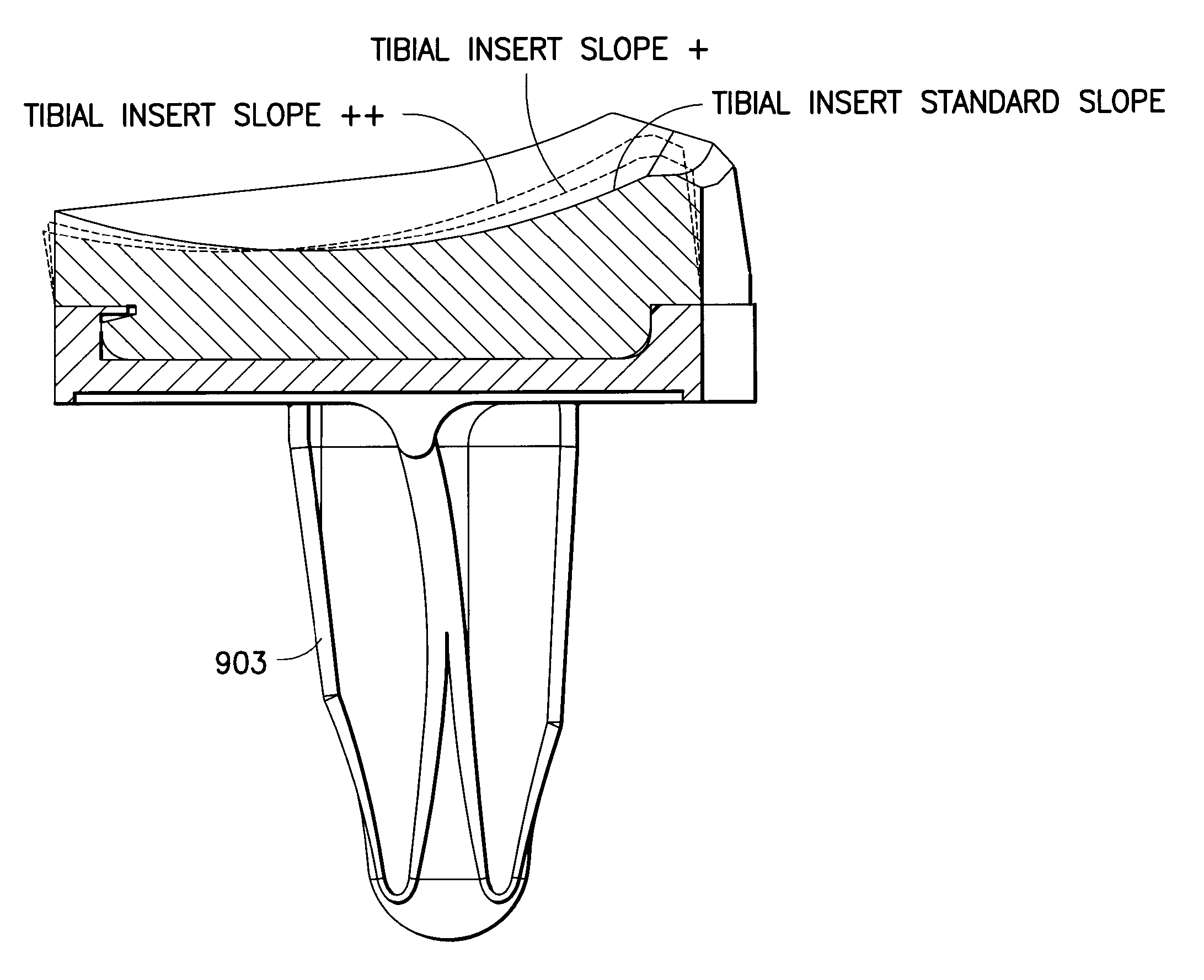 Knee prosthesis system with at least a first tibial portion element (a tibial insert or tibial trial) and a second tibial portion element (a tibial insert or tibial trial), wherein each of the first tibial portion element and the second tibial portion element has a different slope