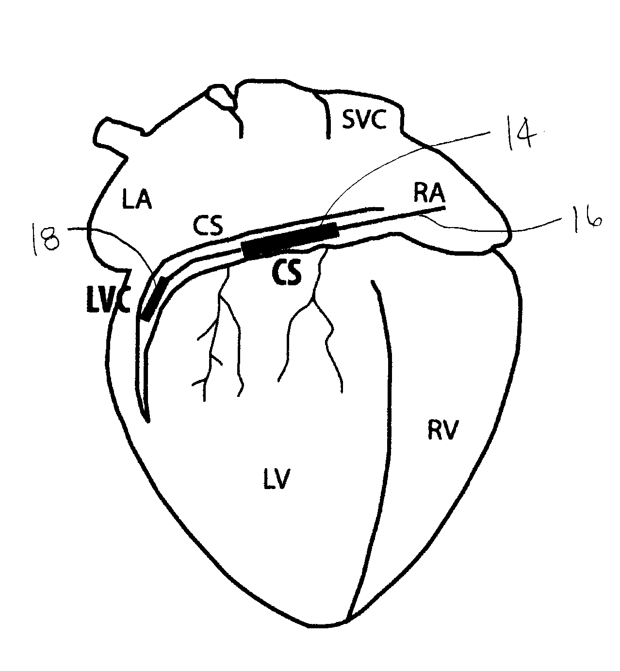 Methods and devices for three-stage ventricular therapy