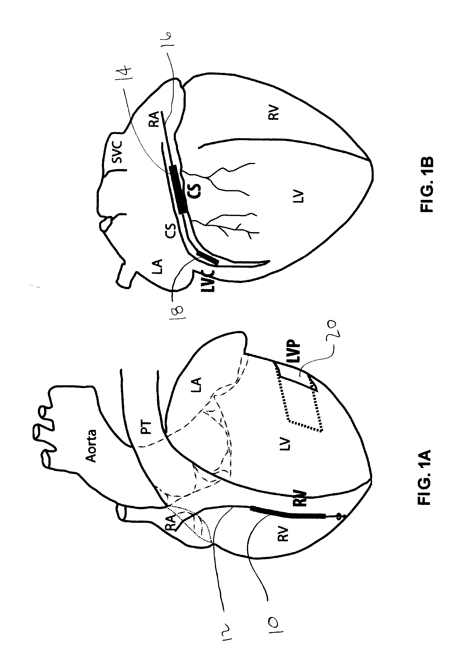 Methods and devices for three-stage ventricular therapy