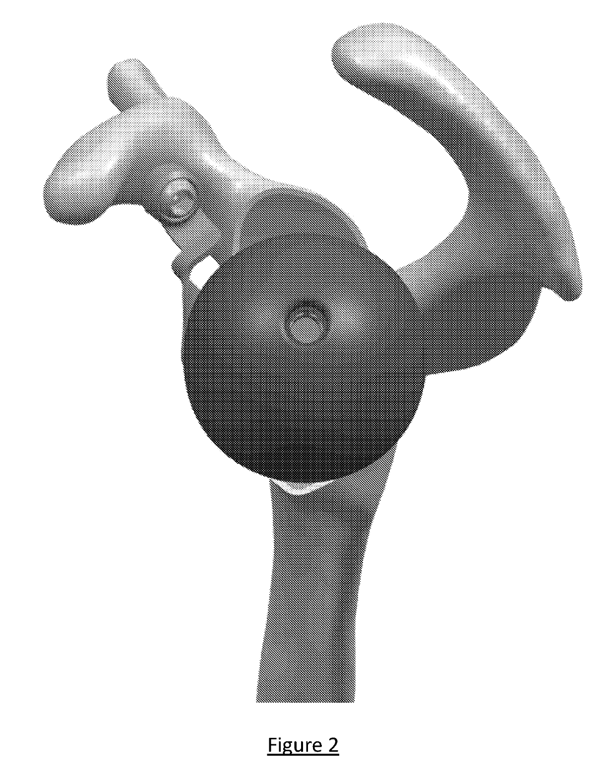 Platform rtsa glenoid prosthesis with modular attachments capable of improving initial fixation, fracture reconstructions, and joint biomechanics