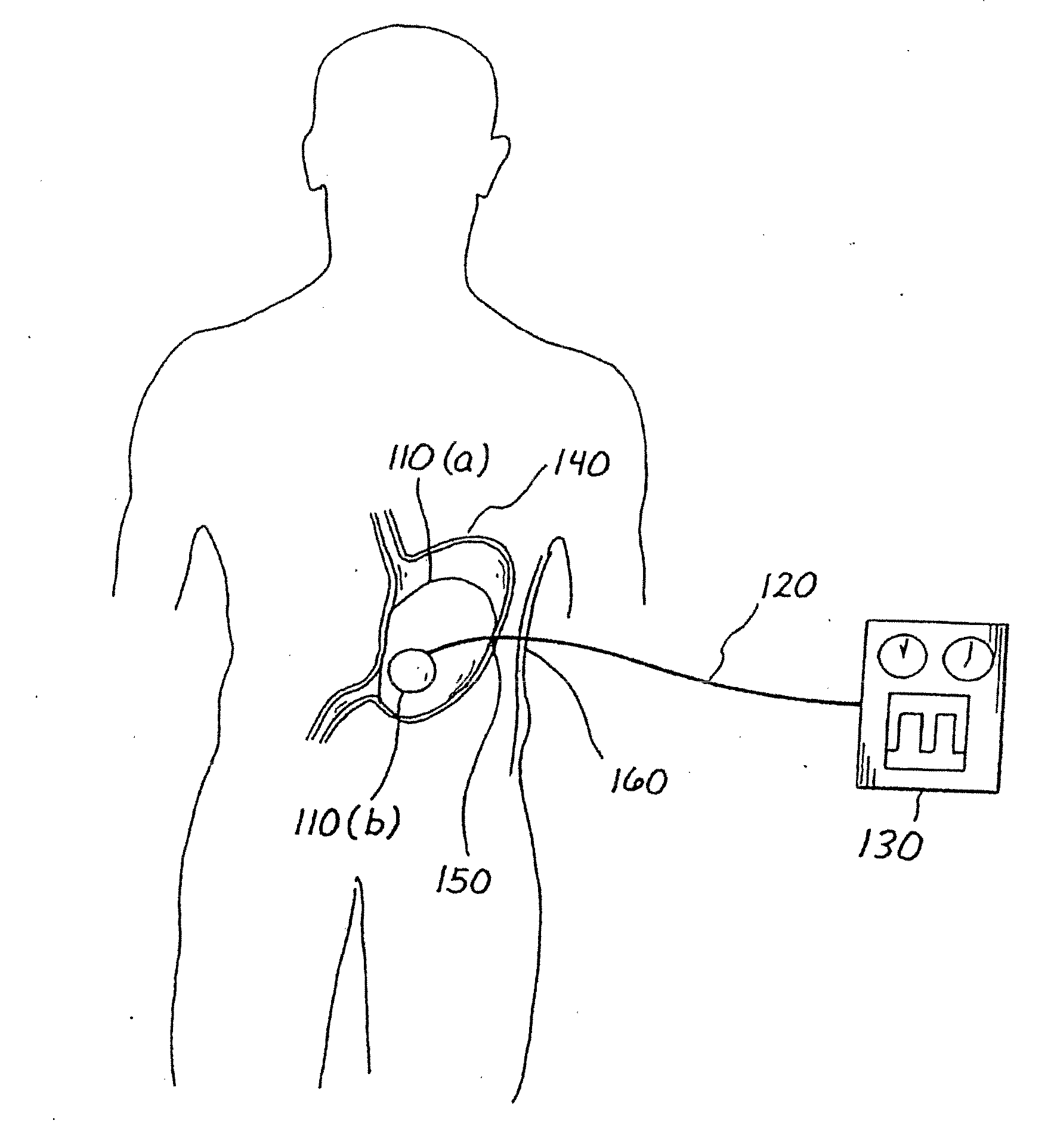 Balloon system and methods for treating obesity