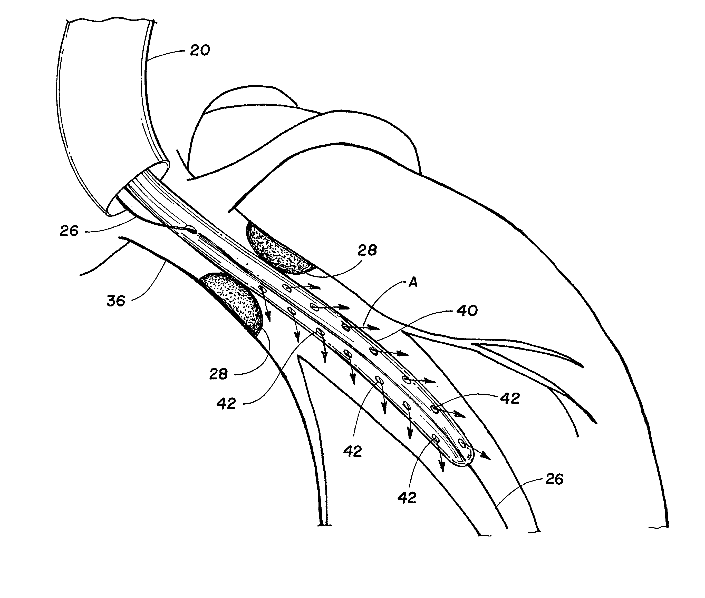 Perfusion procedure and apparatus for preventing necrosis following failed balloon angioplasty