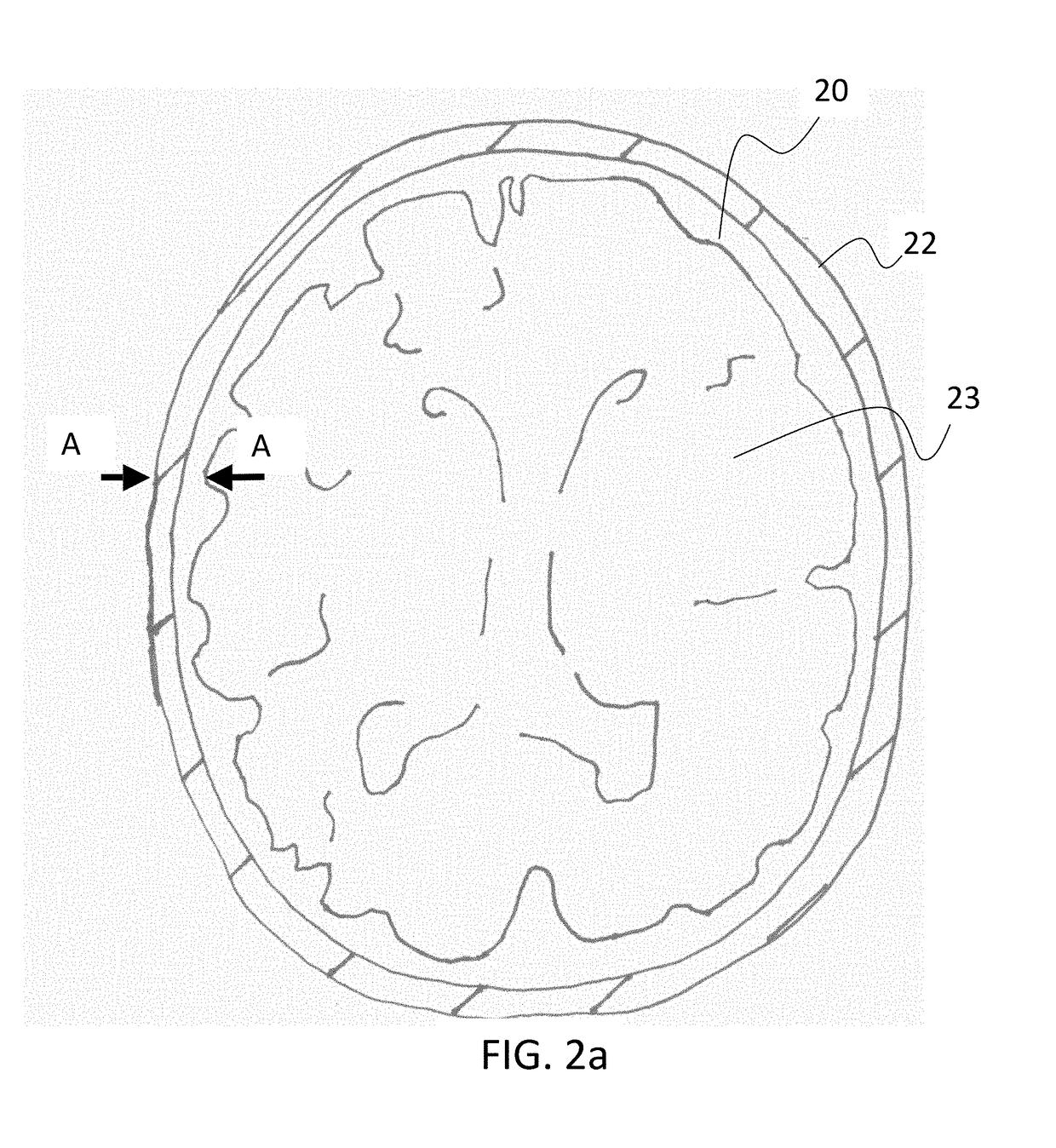 Apparatus and methods for detecting increase in intracranial pressure