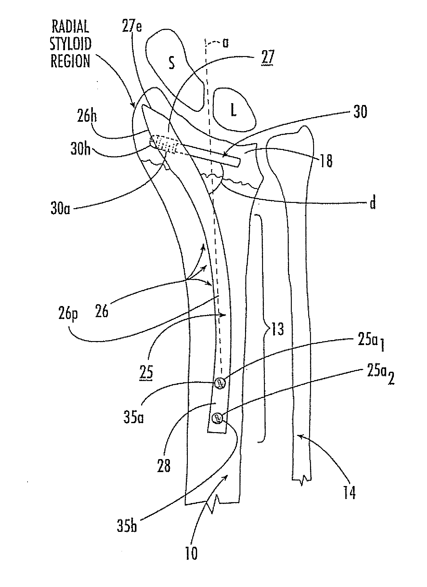 Kits with intramedullary interlocking fixation devices for the distal radius