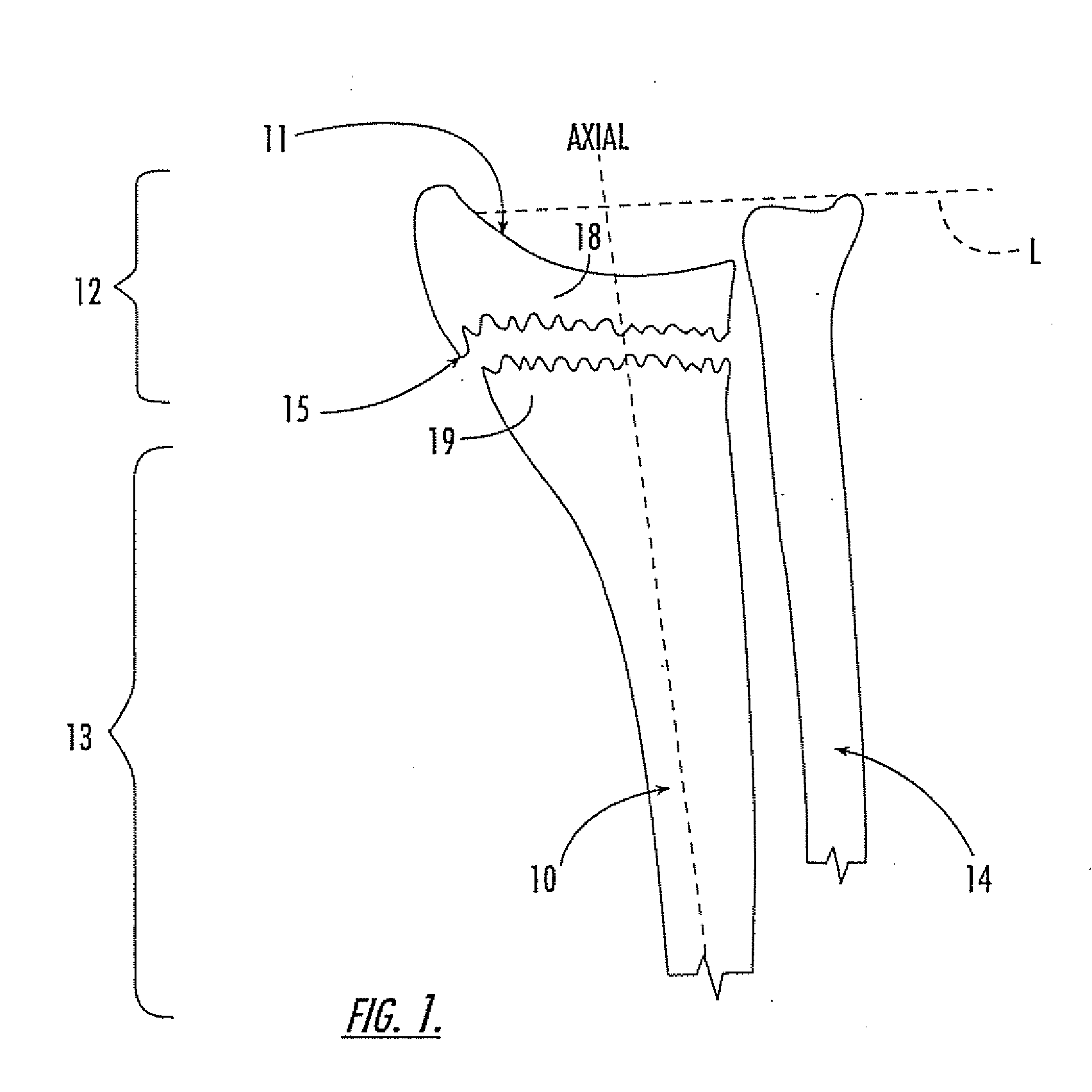 Kits with intramedullary interlocking fixation devices for the distal radius