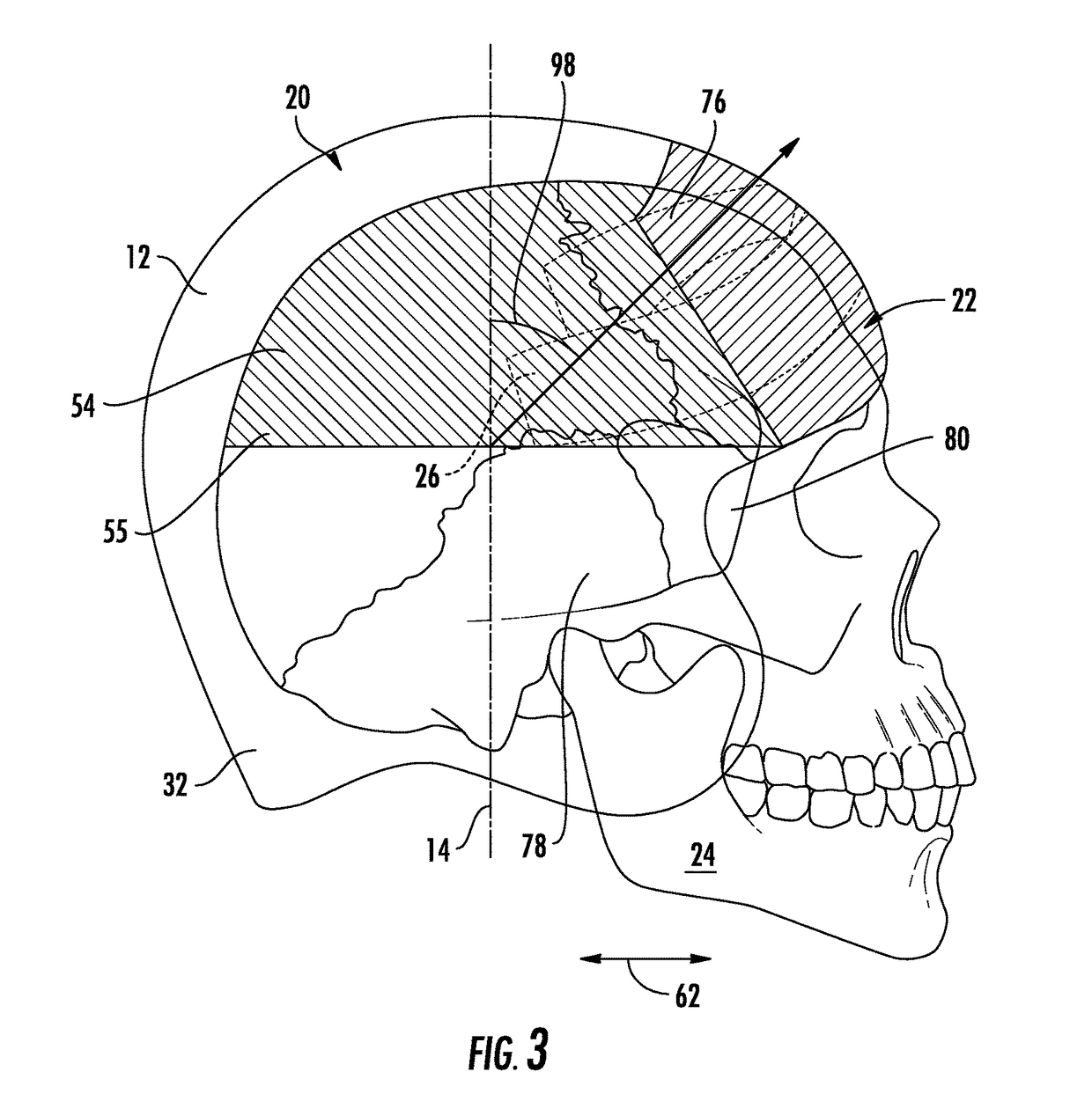 Headgear system with impact reduction feature