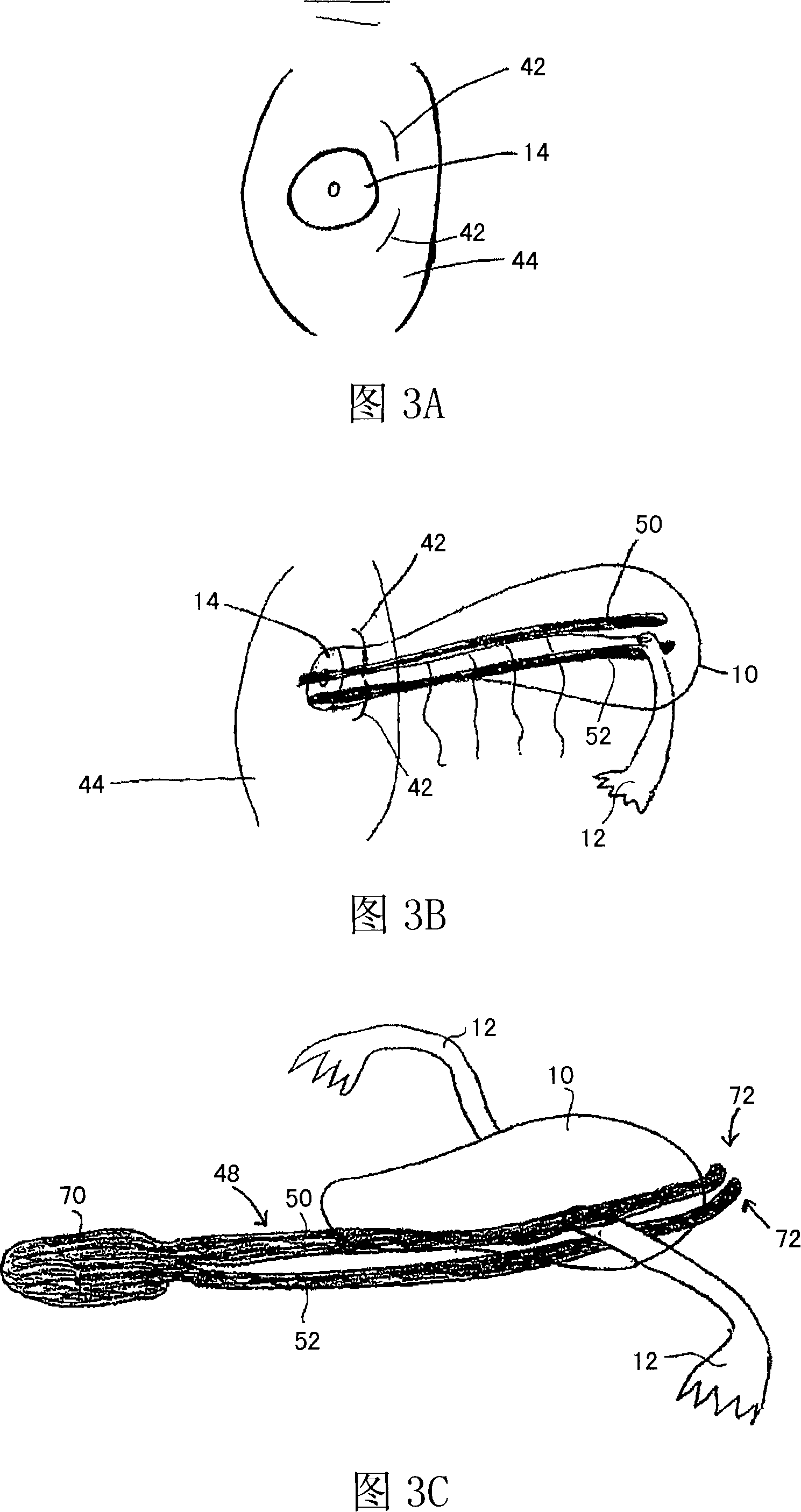 Method and apparatus for performing a surgical procedure
