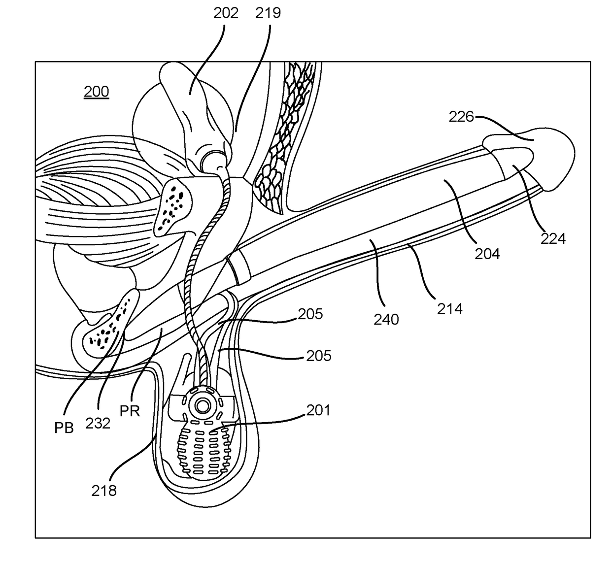 Inflatable penile prosthesis with reversible flow pump