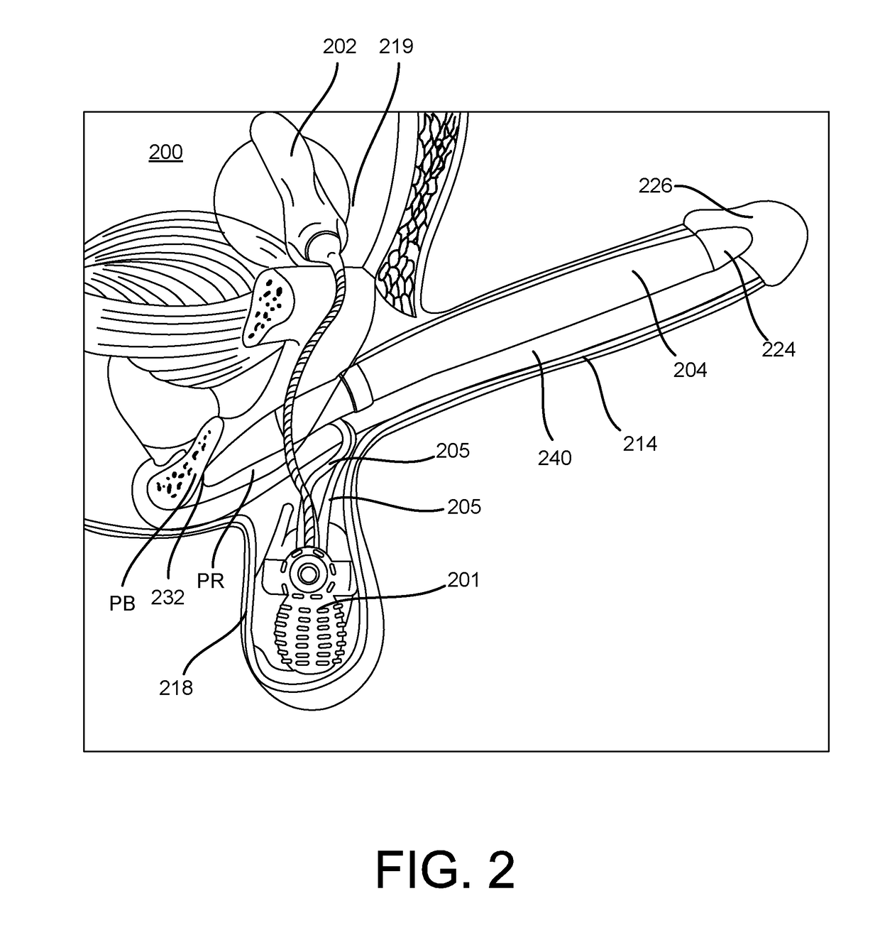 Inflatable penile prosthesis with reversible flow pump